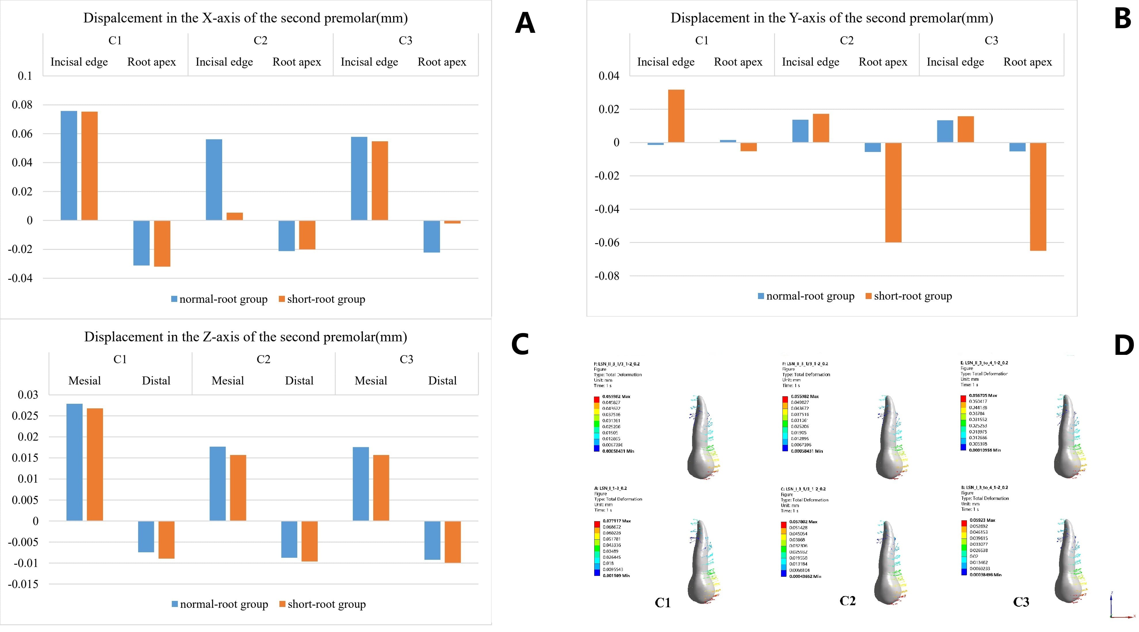 Movement of the second premolar. (A,C) The greatest
displacement occurred along the X-axis and Z-axis under C1. (B) In the
normal-root group, a slight buccal inclination of the crown was observed along
the Y-axis in C1, whereas in other conditions the crown inclined lingually. In
contrast, the short-root group exhibited the greatest lingual inclination of the
crown under C1. (D) Histograms showed the 3D displacement of the second premolar.
The short-root group exhibited less displacement compared to the normal-root
group. Max: maximum; Min: minimum.