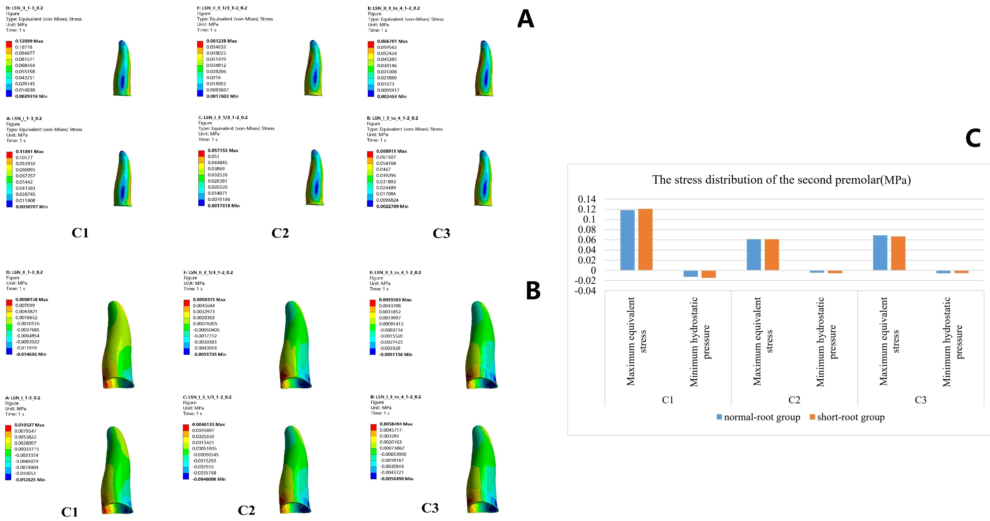 Stress distribution of the second premolar. (A) The largest von
Mises stress of the second premolar was identified in the mesial root area. (B)
The minimum hydrostatic pressure was detected in the mesial cervical area. (C)
The highest stress distribution of the central incisor occurred in C1, while the
lowest stress occurred in C2. Max: maximum; Min: minimum.