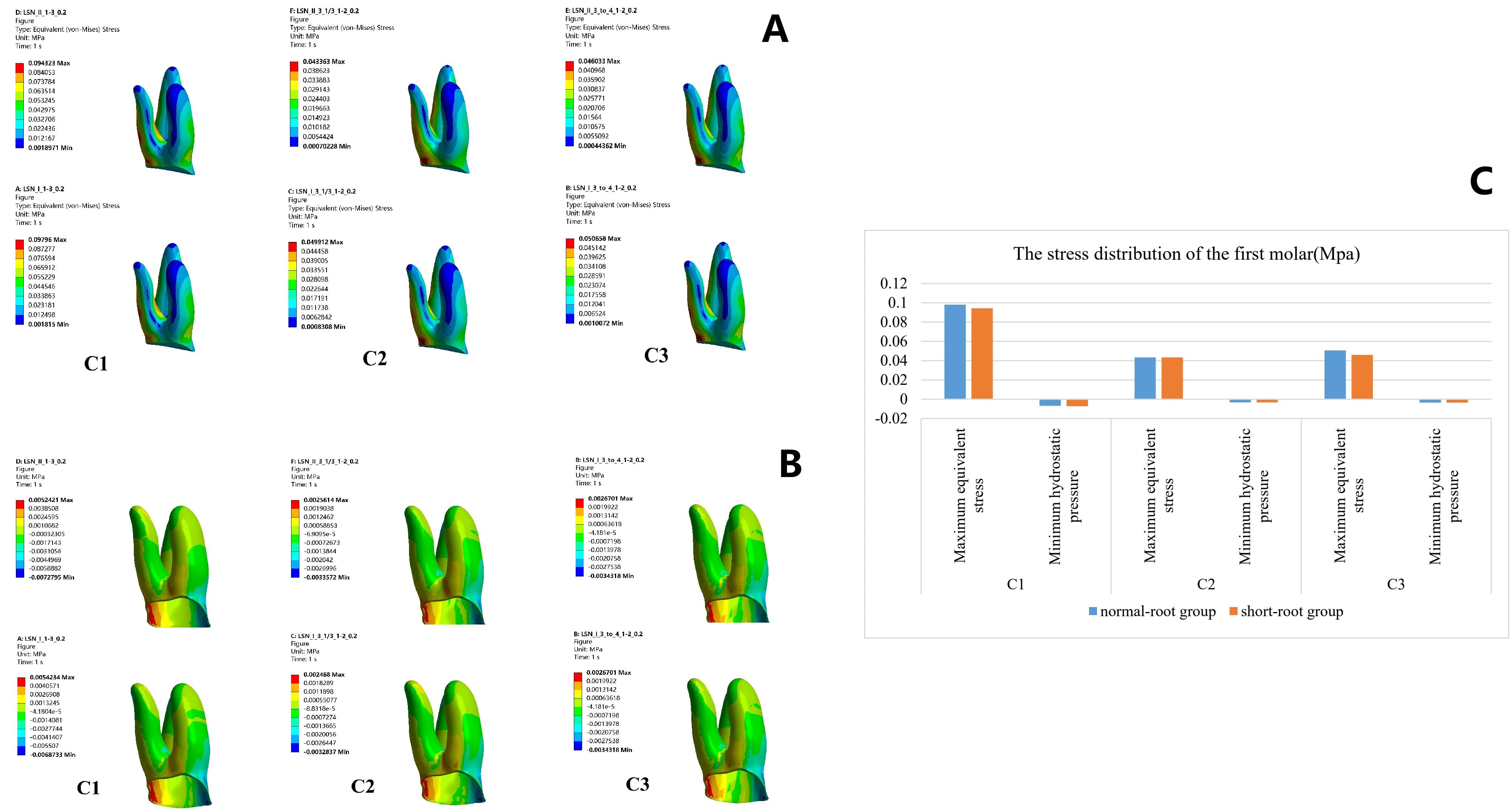 Stress distribution of the first molar. (A) The largest von
Mises stress of the first molar was observed in the distal root area. (B) The
minimum hydrostatic pressure was detected in the mesial cervical area. (C) The
highest stress distribution of the first molar was observed in C1, and the lowest
was in C2. Max: maximum; Min: minimum.