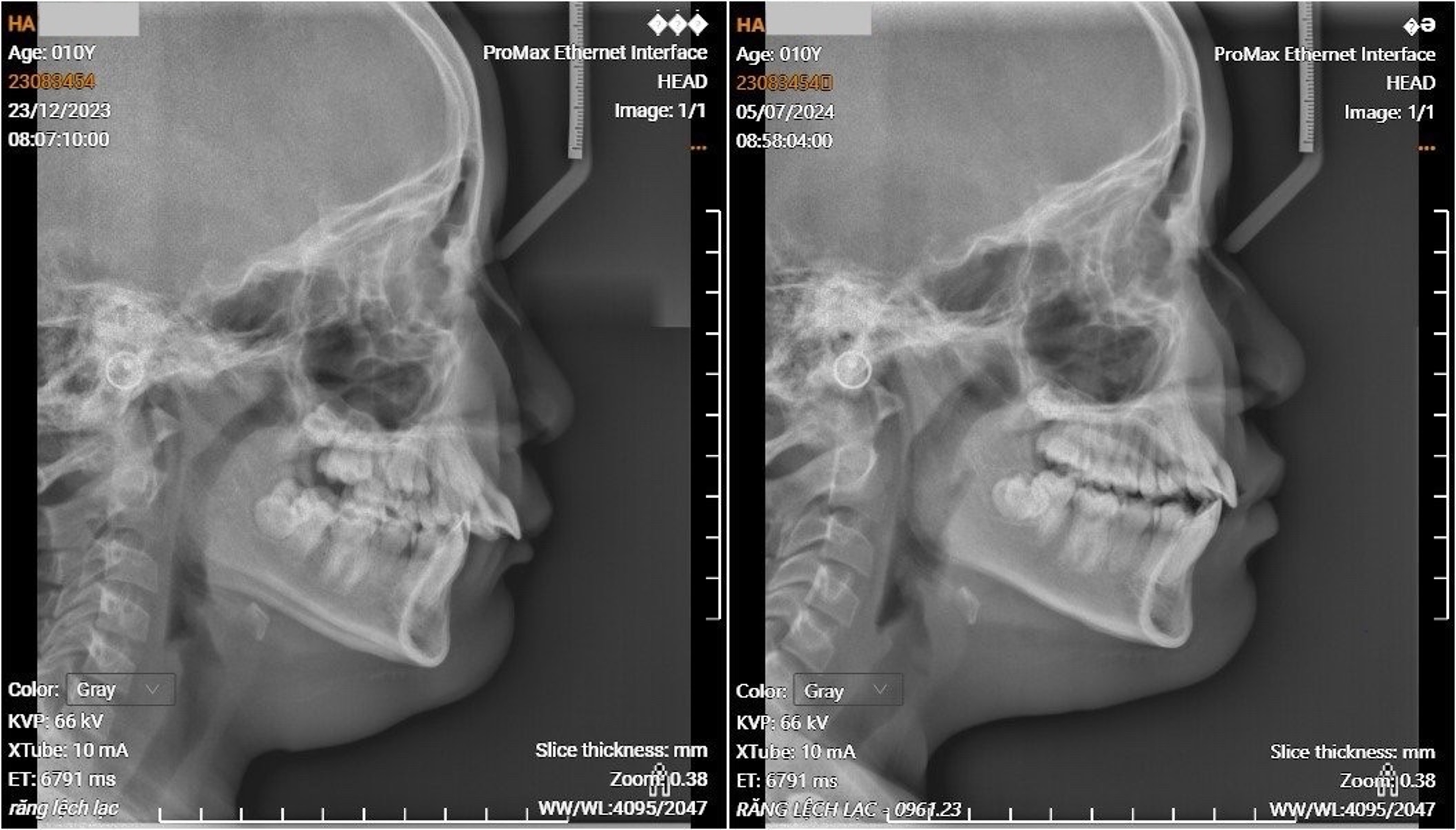 Lateral cephalograms at T0 (before treatment) and T1 after 
treatment (6 months later).