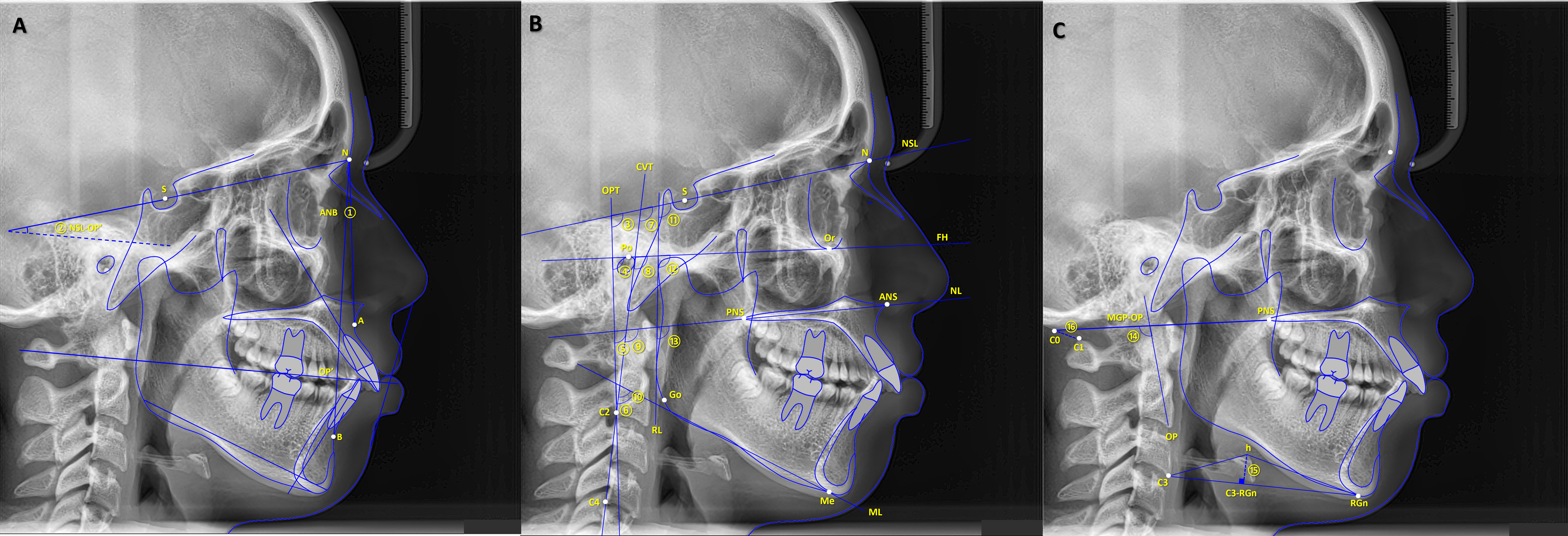 Reference points, lines and angles for measurements according to
Steiner (Fig. 1A), Solow (Fig. 1B), and Rocabado (Fig. 1C): nasion (N), sella
(S), subspinale (A), supramentale (B), occlusal plane (OP’), orbital (Or), porion
(Po), anterior nasal spine (ANS), posterior nasal spine (PNS), mentonian (Me),
gonion (Go), base of the occipital bone (C0), first vertebral cervical (C1),
second cervical vertebra (C2), third cervical vertebra (C3), fourth cervical
vertebra (C4), hyoid (h), retrognation (RGn), nasion‒sella line (NSL), Frankfurt
horizontal (FH), nasal line (NL), mandibular line (ML), odontoid process tangent
(OPT), cervical vertebral tangent (CVT), ramus line (RL), McGregor plane (MGP),
odontoid plane (OP). Parameters: ANB: point A‒nasion line to point B‒nasion line;
NSL-OP’: nasion‒sella line to occlusal plane; NSL-OPT: nasion‒sella line to
odontoid process tangent; FH-OPT: Frankfurt horizontal to odontoid process
tangent; NL-OPT: nasal line to odontoid process tangent; ML-OPT: mandibular line
to odontoid process tangent; NSL-CVT: nasion‒sella line to cervical vertebral
tangent; FH-CVT: Frankfurt horizontal to cervical vertebral tangent; NL-CVT:
nasal line to cervical vertebral tangent; ML-CVT: mandibular line to cervical
vertebral tangent; NSL-RL: nasion‒sella line to ramus line; FH-RL: Frankfurt
horizontal to ramus line; NL-RL: nasal line to ramus line; MGP-OP: McGregor plane
to odontoid plane; H: point “h” to C3-RGn line; C0–C1: distance from C0 to
C1.