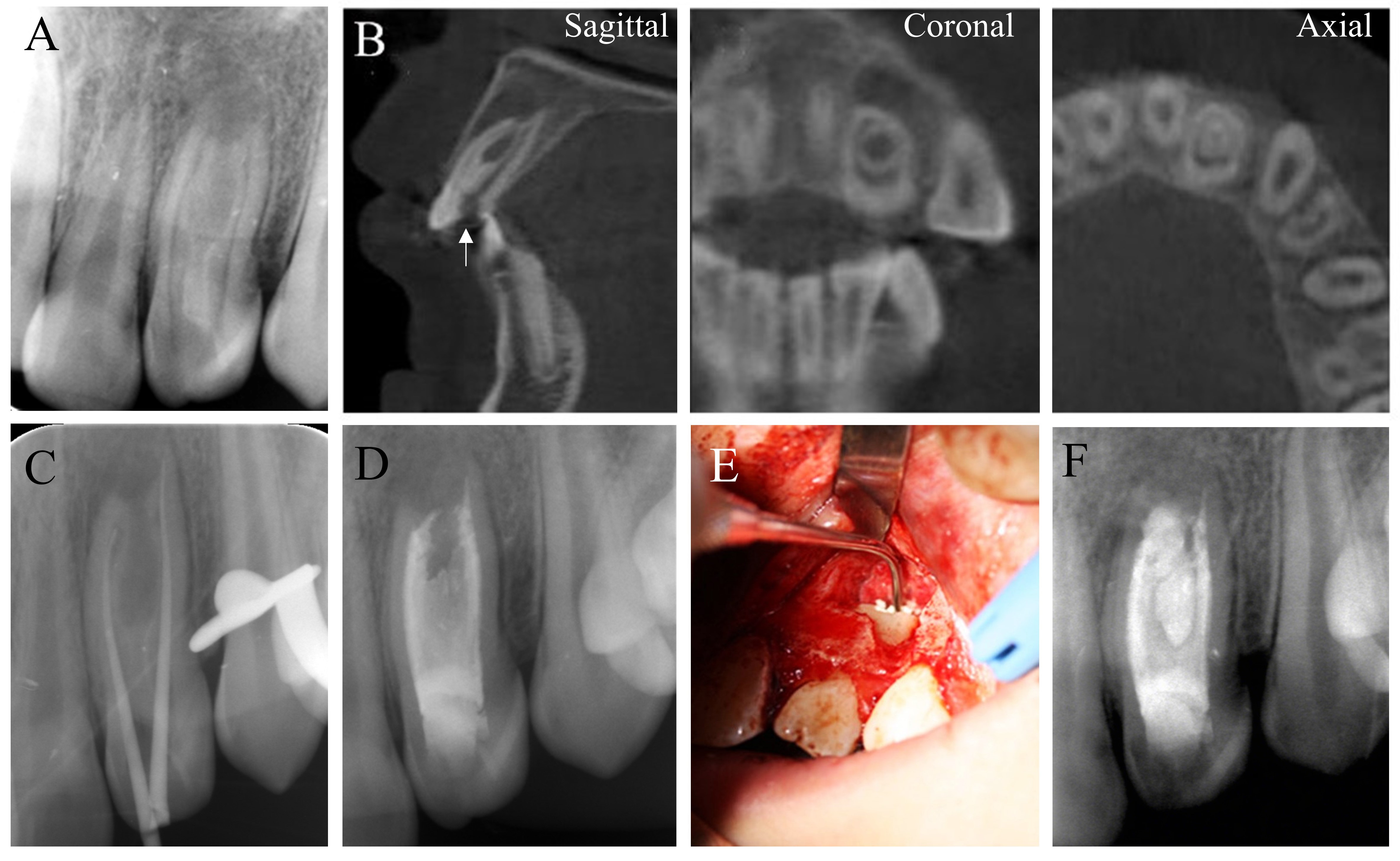 The treatment and radiographs of case 1. (A,B) Preoperative
periapical radiograph and CBCT images of the CDI. White arrow indicated that an
access to the pulp chamber had already been made before the initial visit. (C,D)
Non-surgical root canal treatment with warm vertical compaction. (E) Periodontal
surgery and retrograde filling of the invagination. The approach was made from
the labial side. (F) Postoperative periapical radiograph after retrograde filling
of the invagination.