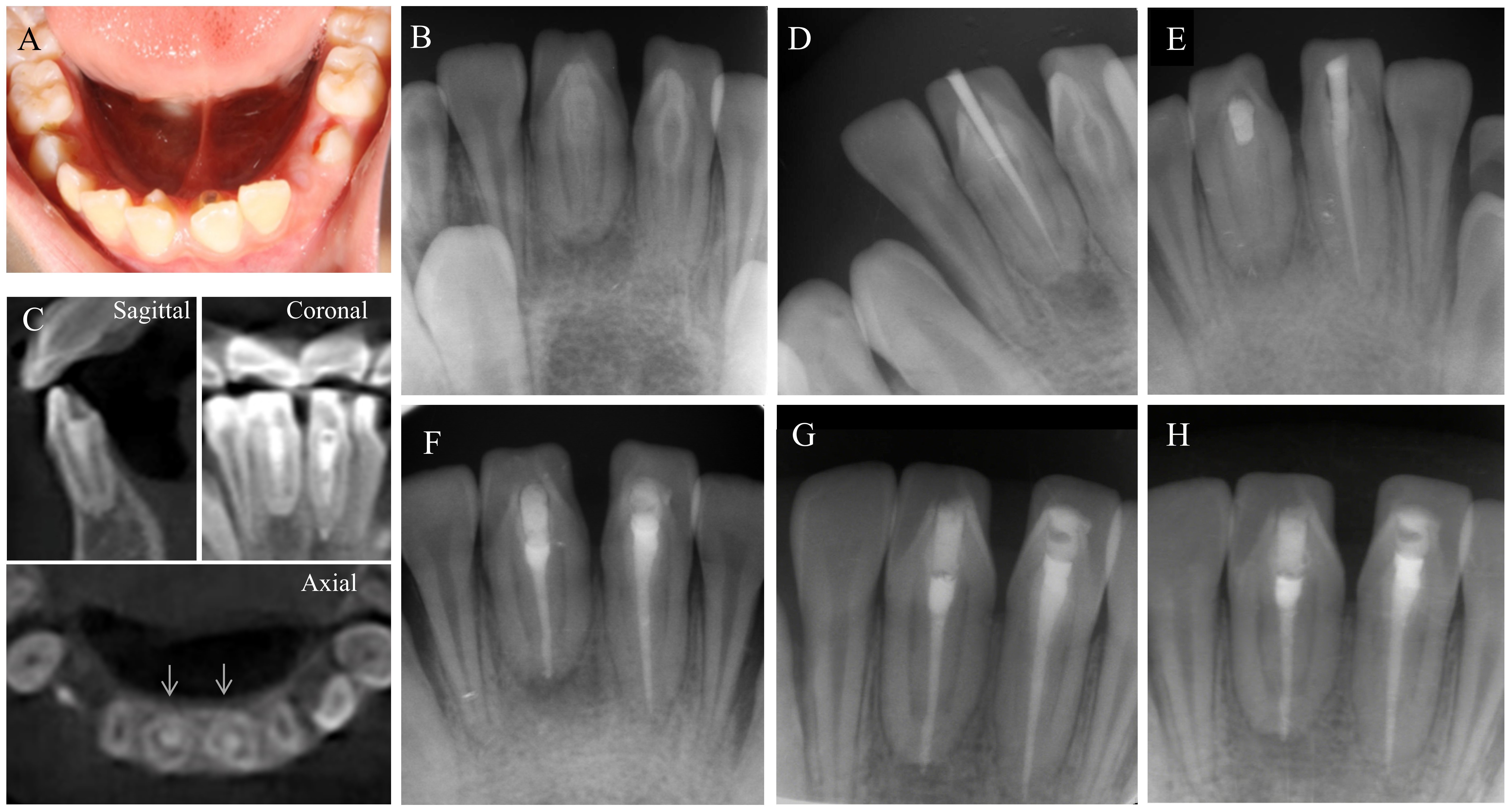 The treatment and radiographs of case 2. (A) Preoperative
clinical views. (B) Preoperative periapical radiograph image of the
invaginations. (C) Intraoperative CBCT images after intracanal medicament of
invaginated canals. (D,E) Apical barriers and filling of the invaginations.
(F–H) Postoperative radiographs after MTA and warm gutta-percha obturation of
the invaginated root canal at 1, 3 and 6-month recall. It was observed that
periapical lesions healed over time.
