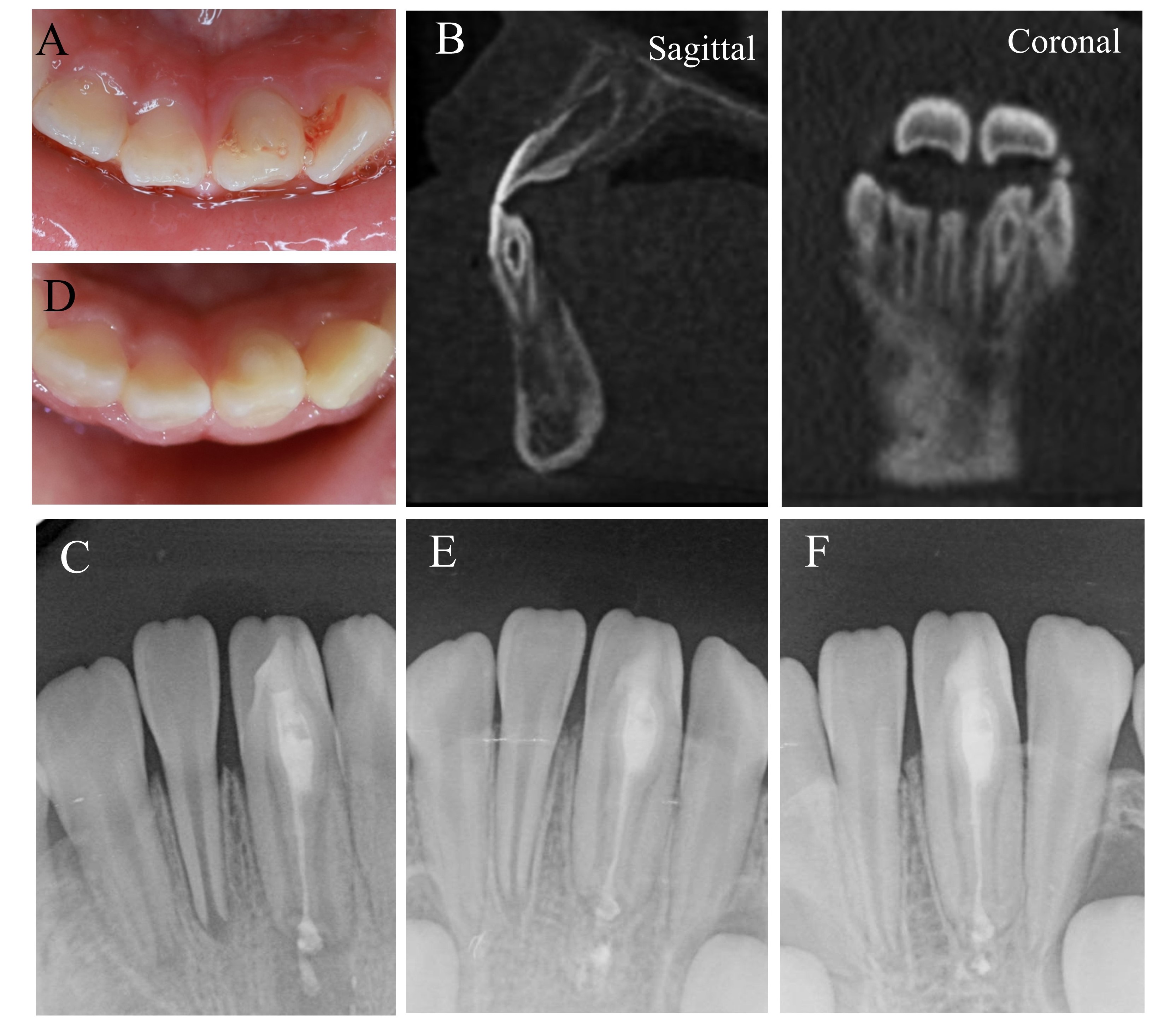 The treatment and radiographs of case 3. (A) Preoperative
clinical view. (B) Preoperative CBCT images of the CDI. (C) Postoperative
periapical radiograph after the invaginated canal filling immediately. (D)
Postoperative clinical view at 7-month recall. (E,F) Postoperative periapical
radiograph at 7-month and 18-month recall. Over time, root lengthening, apical
foramen closing, and thickening of the root canal wall were observed.
Additionally, the overfilled iRoot SP sealer paste does not affect the healing
process of the periapical region due to its superior biocompatibility and
therefore does not need more intervention.
