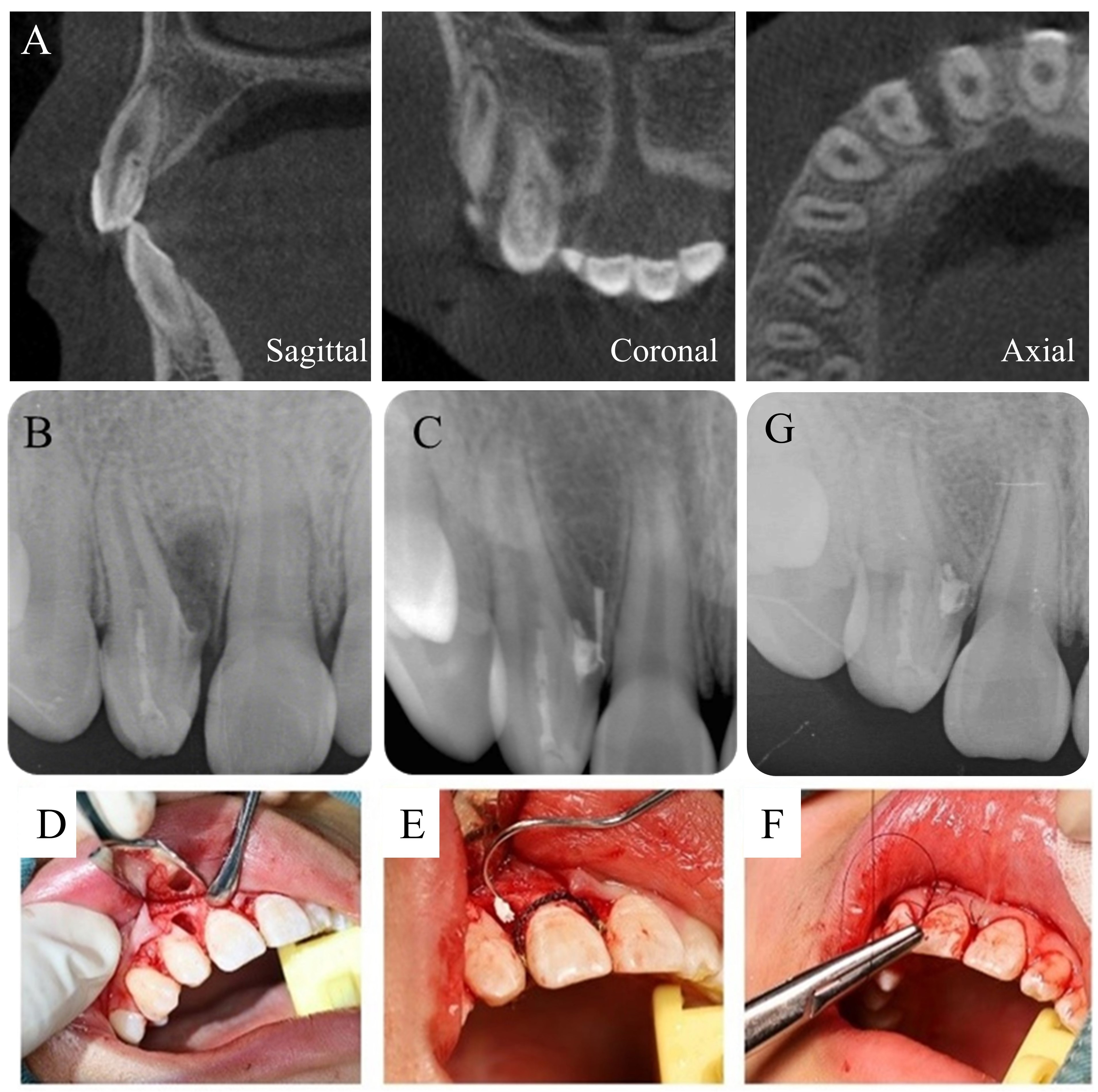 The treatment and radiographs of case 4. (A) Preoperative CBCT
images of the DI. (B) Filling of type II CDI. (C) Filling of type III CDI,
gutta-percha point shows the sinus tract. (D–F) Periodontal surgery and
retrograde filling of the invagination. (G) Postoperative radiograph after
retrograde filling at 3-month recall.