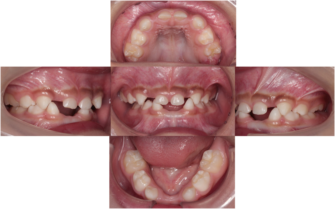 Intraoral photograph at the initial visit. Dental
formula: “EDCA┴ACDE” and “EDC┬CDE”; Missing teeth: B┴B and BA┬AB.