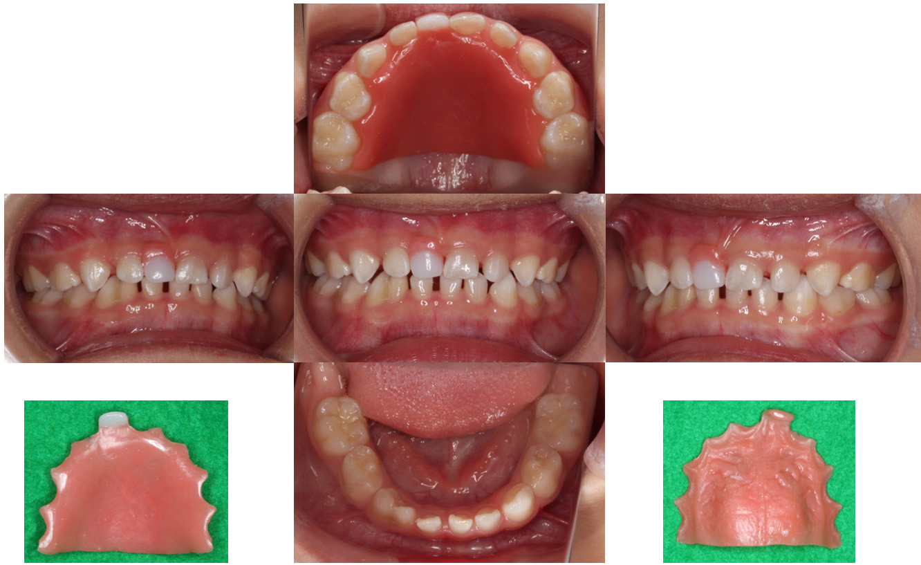 Intraoral photograph of the RSM fabricated using the
brush-dip technique.