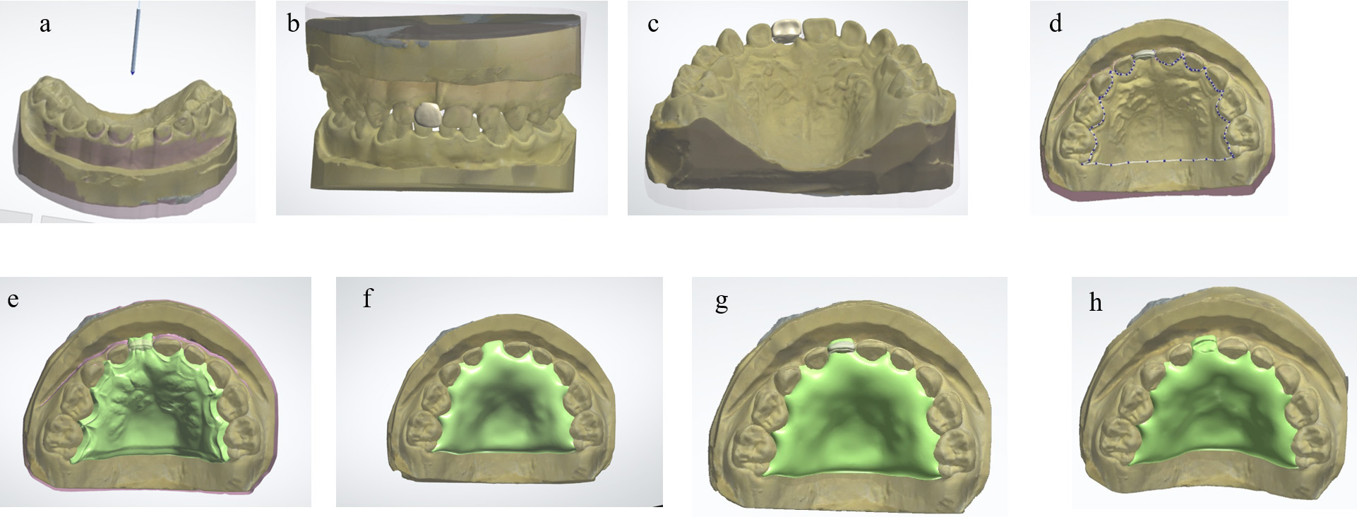 RSM design using computer-aided design software. (a)
Attachment and removal direction determination. (b,c) Artificial tooth
arrangement. (d) Outline configuration of the RSM. (e) A 0.2-mm wax-up applied to
the outline. (f) Final design of the denture base. (g) Completed RSM design. (h)
Final design of the denture plate incorporating the female component.