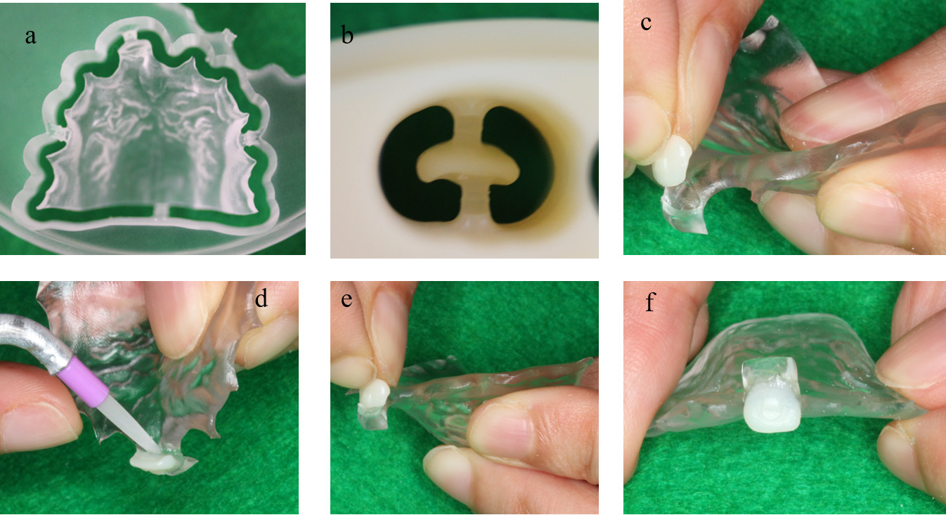 Bonding of artificial teeth to the denture plate. (a)
Denture plate fabrication via subtractive manufacturing. (b) Artificial teeth
fabrication via subtractive manufacturing. (c) Fit confirmation of the artificial
teeth and denture plate. (d) Application of self-curing resin (UNIFAST III, GC,
Tokyo, Japan) to the denture base. (e) Bonding of the denture plate and
artificial teeth. (f) Final bonded denture assembly.