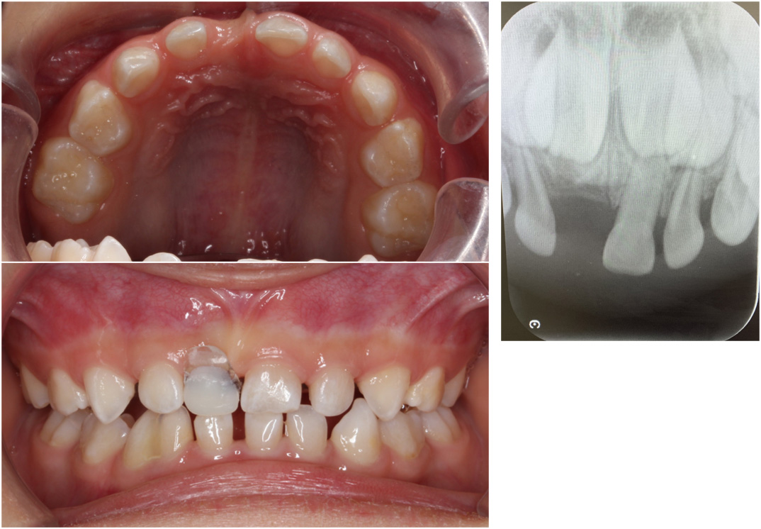 Intraoral photograph and radiograph taken 3 months
after RSM placement.