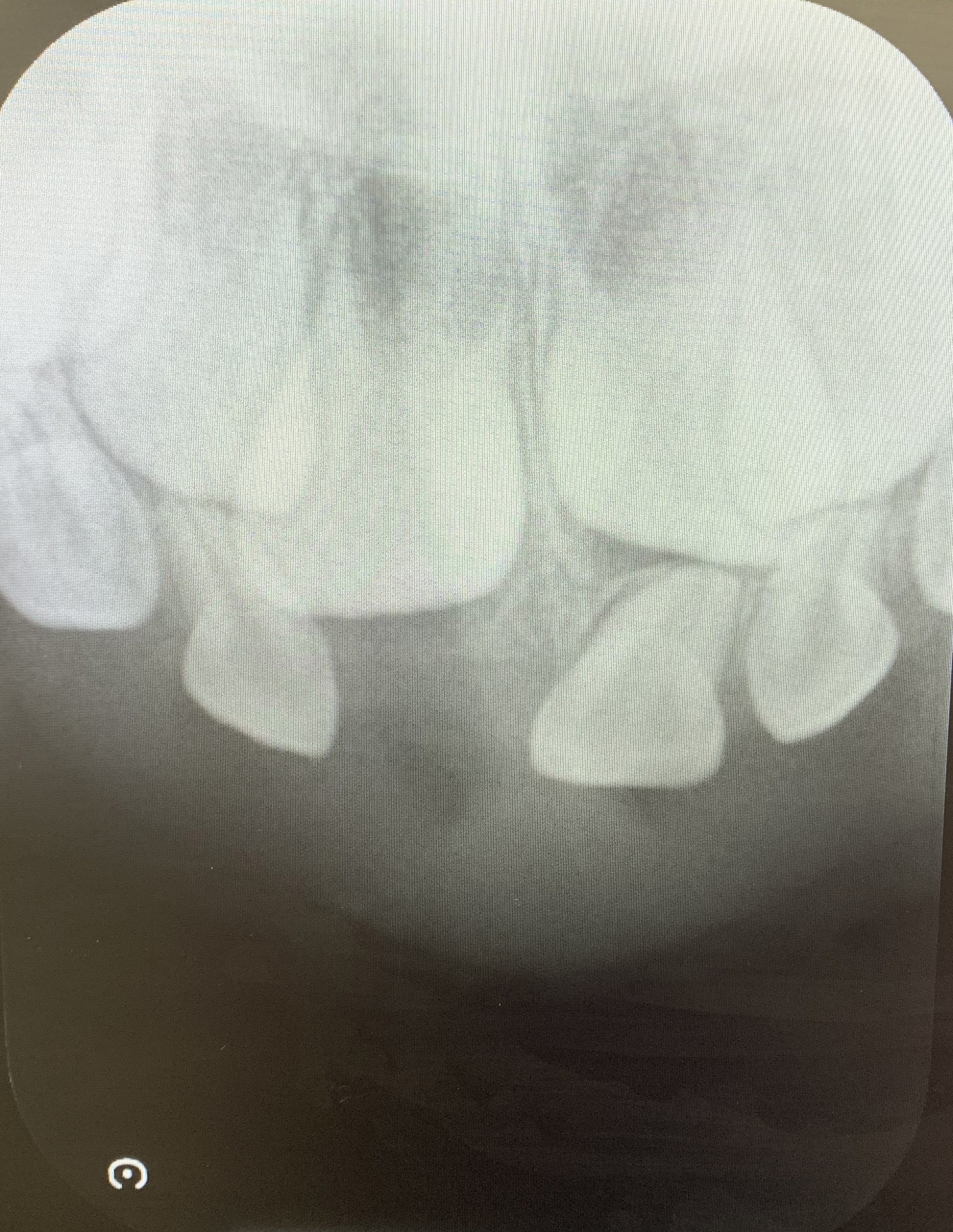Dental radiograph 1 year and 10 months after RSM
placement.