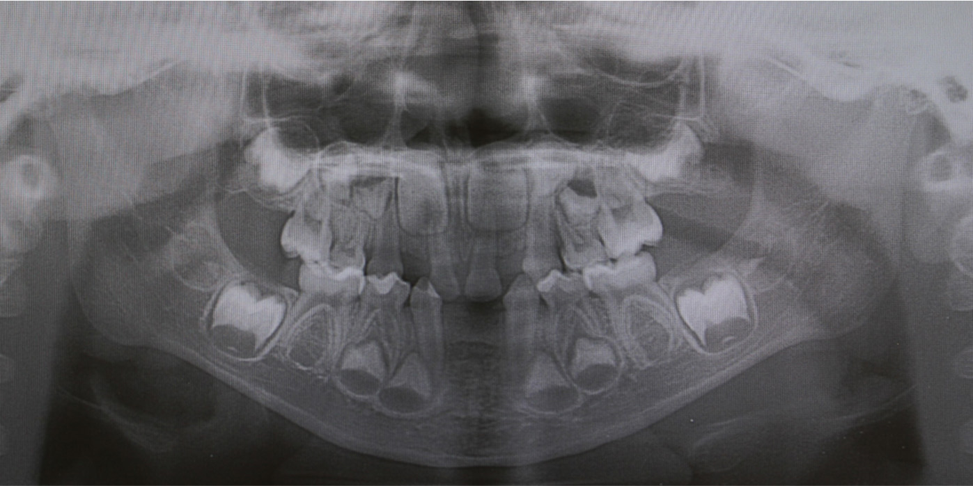 Panoramic radiograph taken at the initial visit.