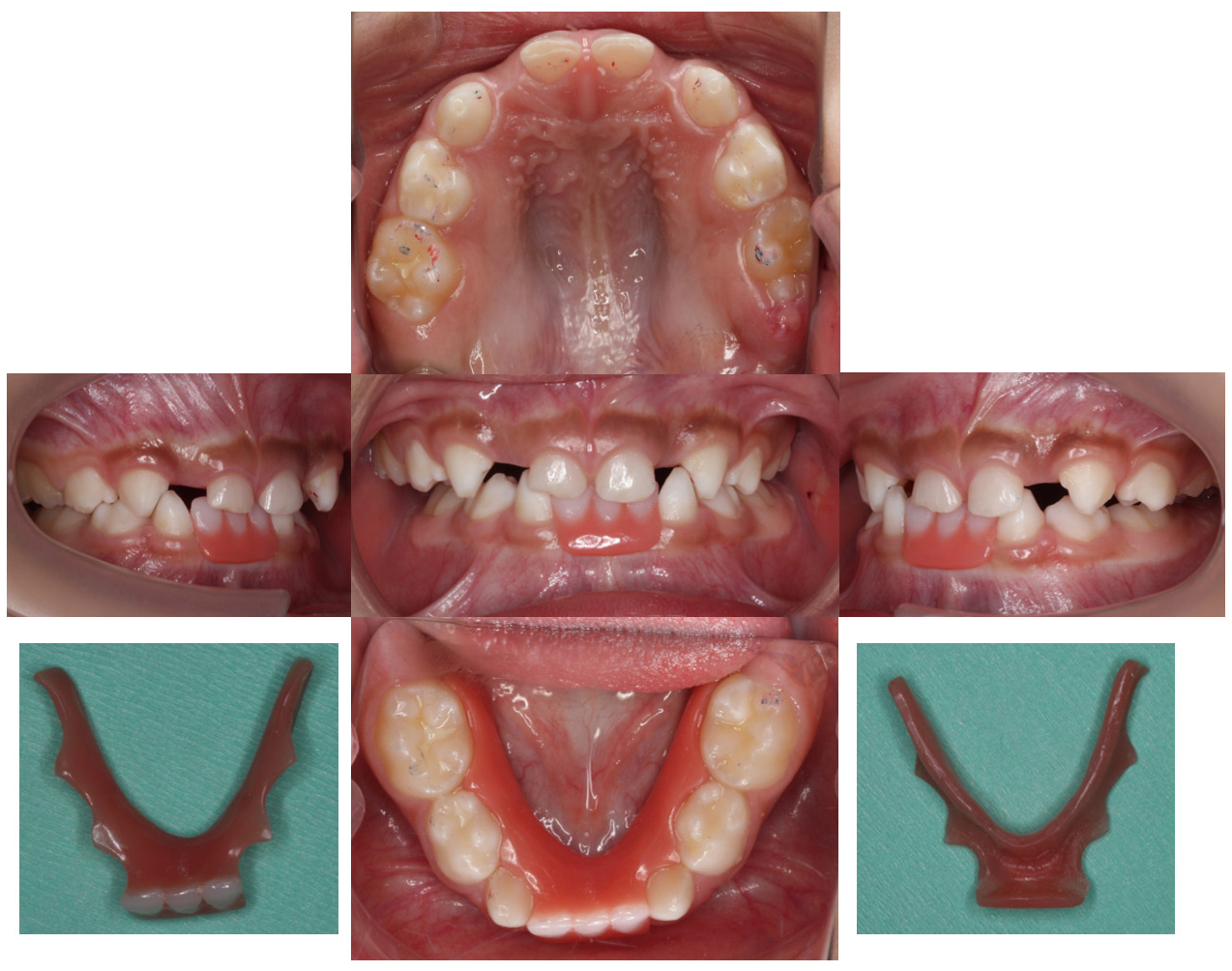 Intraoral photograph of the RSM fabricated using the
brush-dip technique. Missing teeth: BA┬AB.