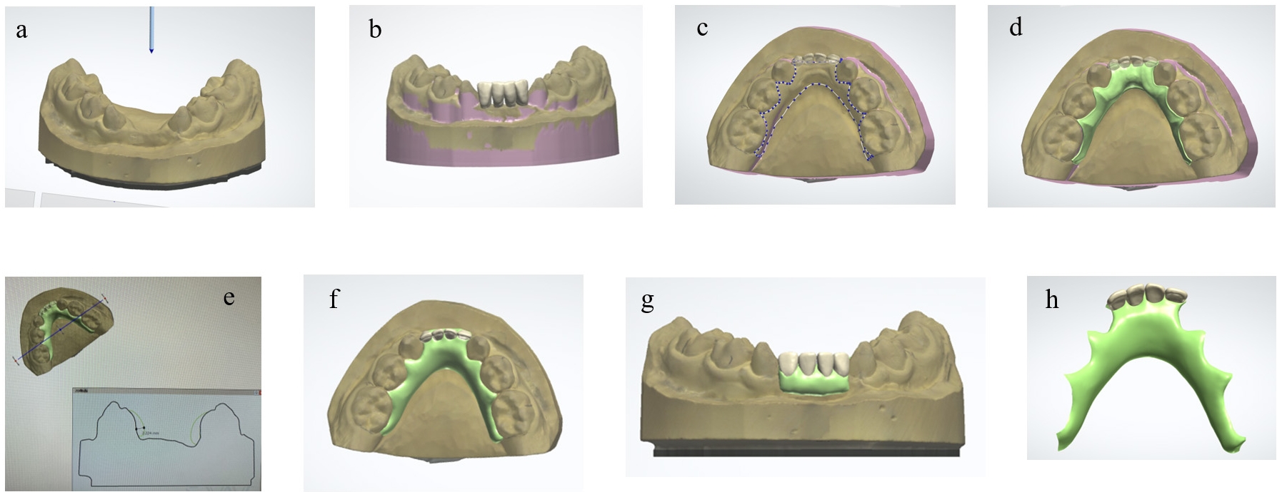 RSM design using computer-aided design software. (a)
Attachment and removal direction determination. (b) Artificial tooth arrangement.
(c) RSM outline configuration. (d) A 0.2-mm wax-up applied to the outline. (e)
Confirmation of thickness. (f–h) Completed RSM design.