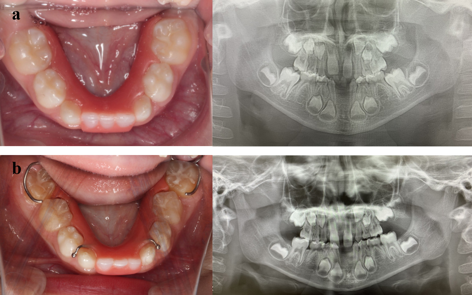 Follow-up panoramic radiographs. (a) Intraoral
photograph and panoramic radiograph at 7 years and 1 month of age. (b) Intraoral
photograph and panoramic radiograph at 8 years and 1 month of age.
