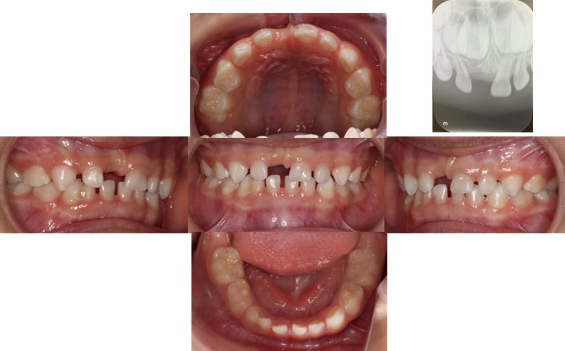 Intraoral photograph and radiograph at the initial
visit.