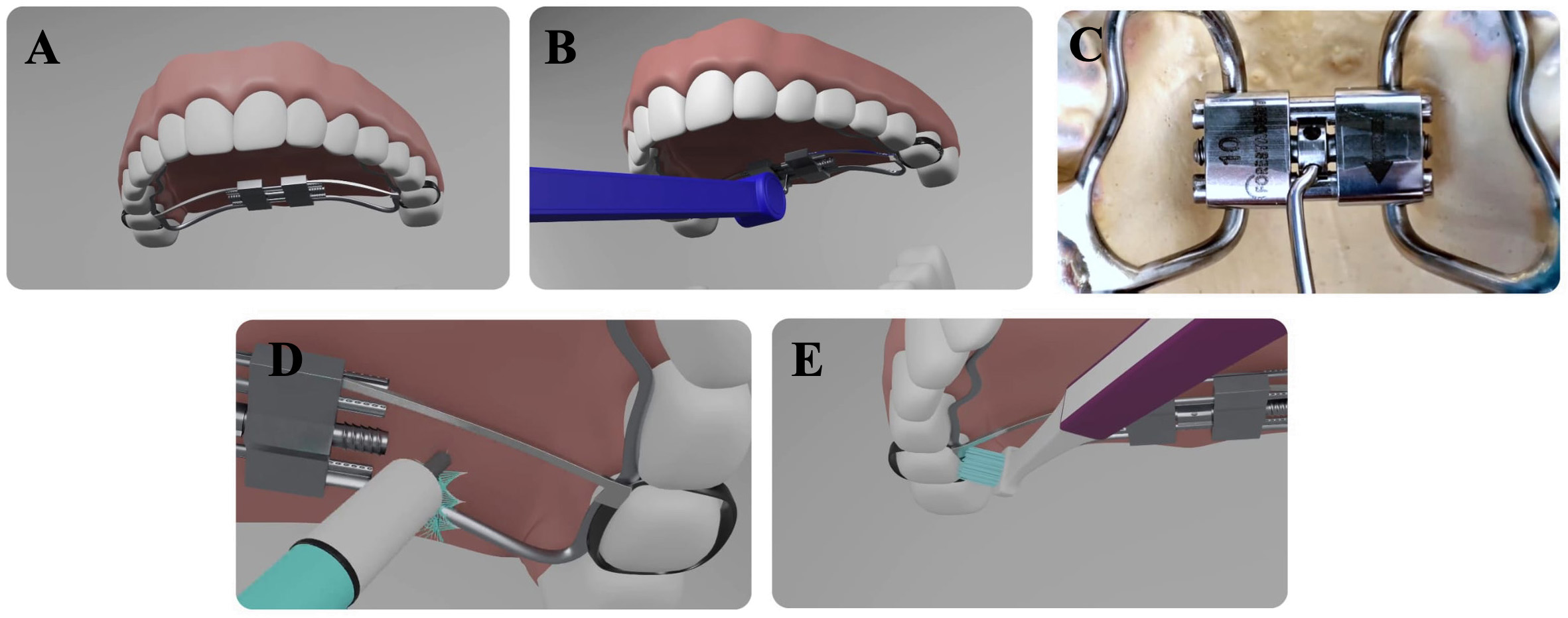 Frames from videos regarding RPE treatment. (A) RPE appliance
placed, (B) activation of the RPE, (C) detail of RPE screw, (D) cleaning of the
RPE with interdental brush, (E) cleaning with single-tuft brush.