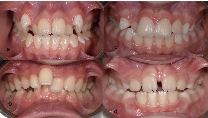 Intraoral images of different dental alignments. (a) case 1 
(severe crowding); (b) case 2 (moderate crowding); (c) case 3 (mild crowding); 
(d) case 4 (diastema).