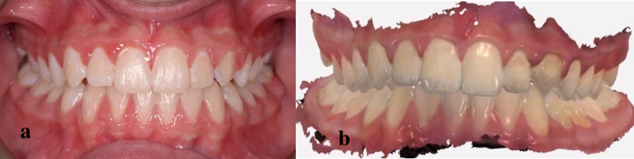 The set of 2D and 3D images of a dental appearance. (a) 2D image 
of normal alignment (case 5). (b) 3D image of normal alignment (case 5).