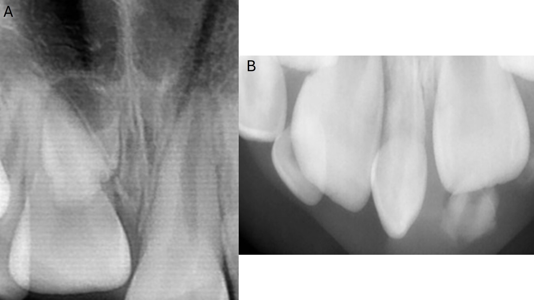 Different types of dental radiographs for the maxillary anterior 
teeth, illustrating different forms of conical mesiodentes. (A) an unerupted 
conical mesiodens with incomplete root formation, which caused malposition of 
permanent incisors. (B) an erupted conical mesiodens with complete root 
formation, which caused malposition of permanent incisors and diastema.