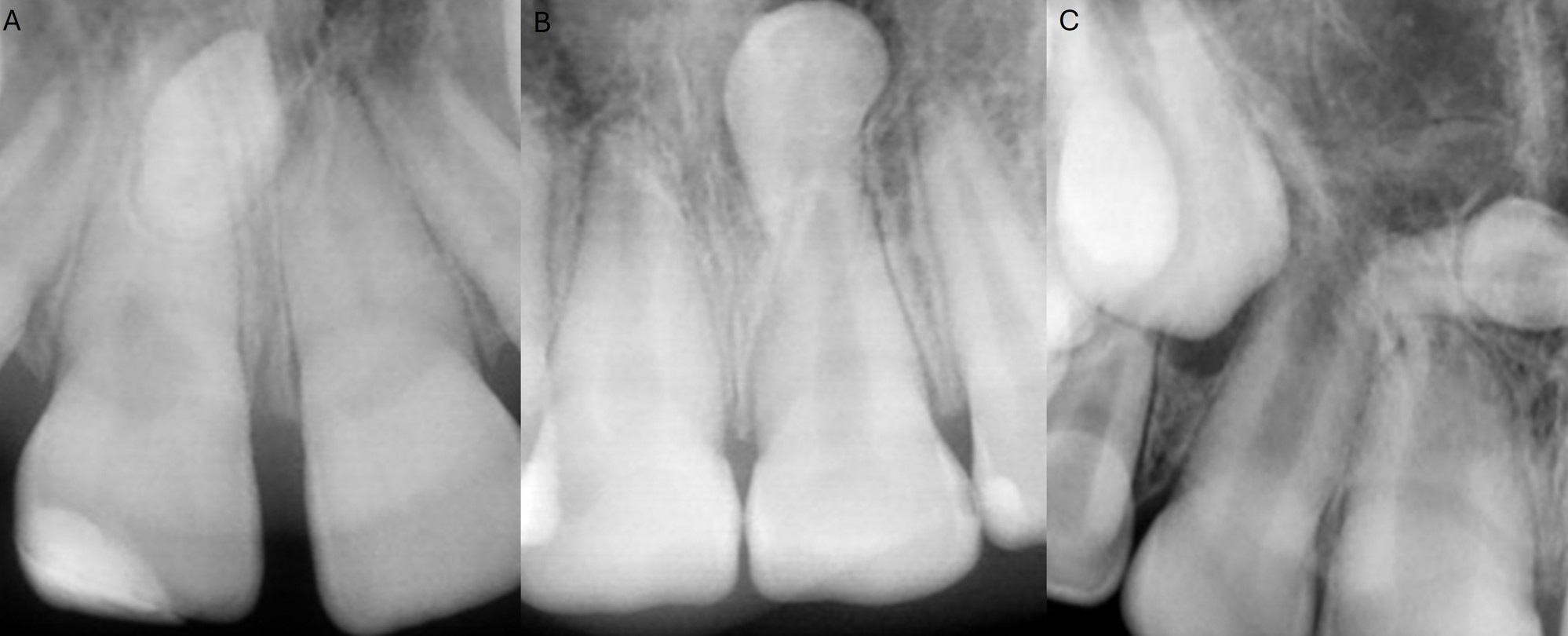 Different types of dental radiographs of the anterior maxillary 
teeth, illustrating different forms of conical mesiodentes. (A) an unerupted 
inverted conical mesiodens with incomplete root formation. (B) an unerupted 
inverted conical mesiodens with complete root formation. (C) an unerupted 
horizontal conical mesiodens with complete root formation.