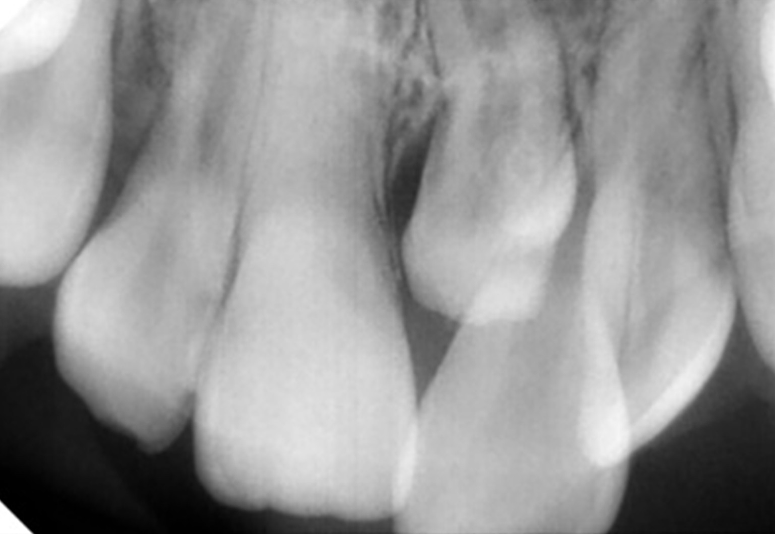 An anterior maxillary dental radiograph illustrating a 
supplemental, an unerupted mesiodens with complete root formation.