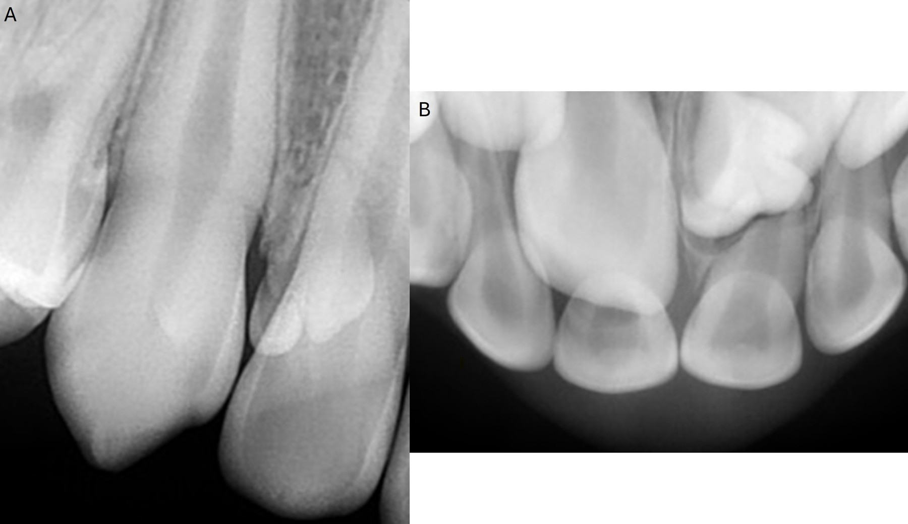 Different types of dental radiographs of anterior maxillary 
teeth, illustrating different forms of mesiodens. (A) an erupted tuberculate 
mesiodens with no evidence of root formation. (B) an unerupted horizontal 
molariform mesiodens with no evidence of root formation.