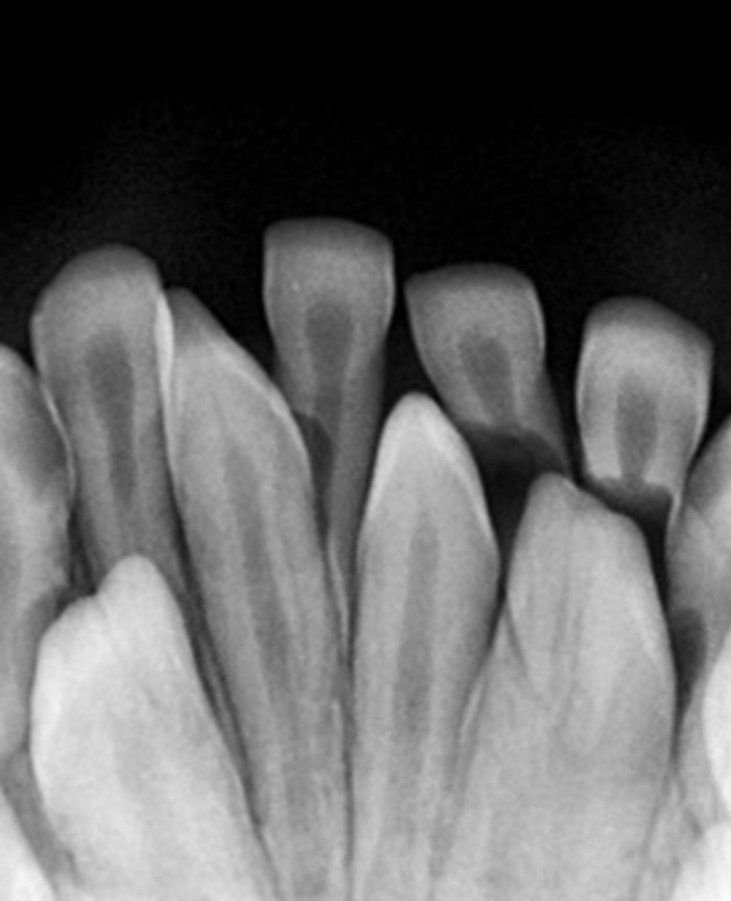 An anterior mandibular radiograph illustrating an erupted 
conical mesiodens with complete root formation.