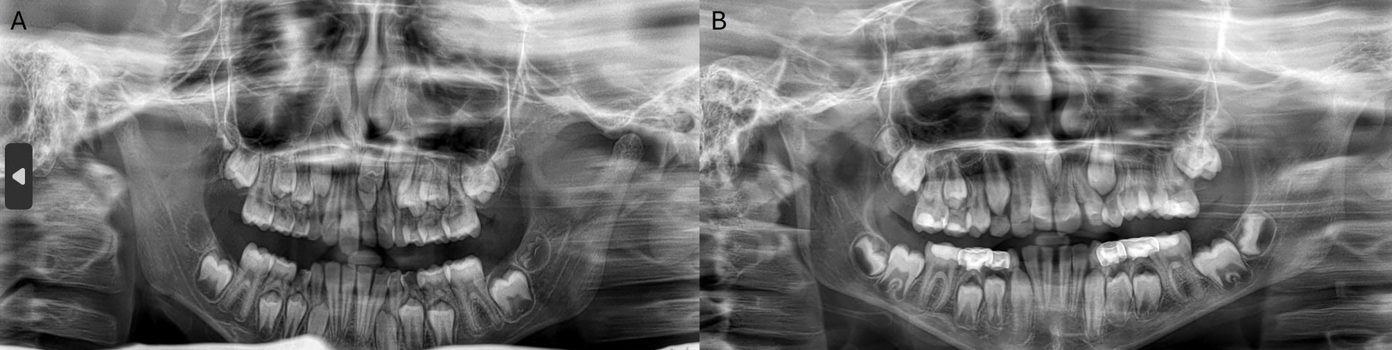 Different orthopantomograms for the patients illustrating 
different forms of conical mesiodens. (A) shows an unerupted conical mesiodens 
with incomplete root formation and causing an impaction of the maxillary left 
permanent incisor with over-retention of the maxillary left primary central 
incisor. (B) shows an unerupted inverted conical mesiodens with complete root 
formation.
