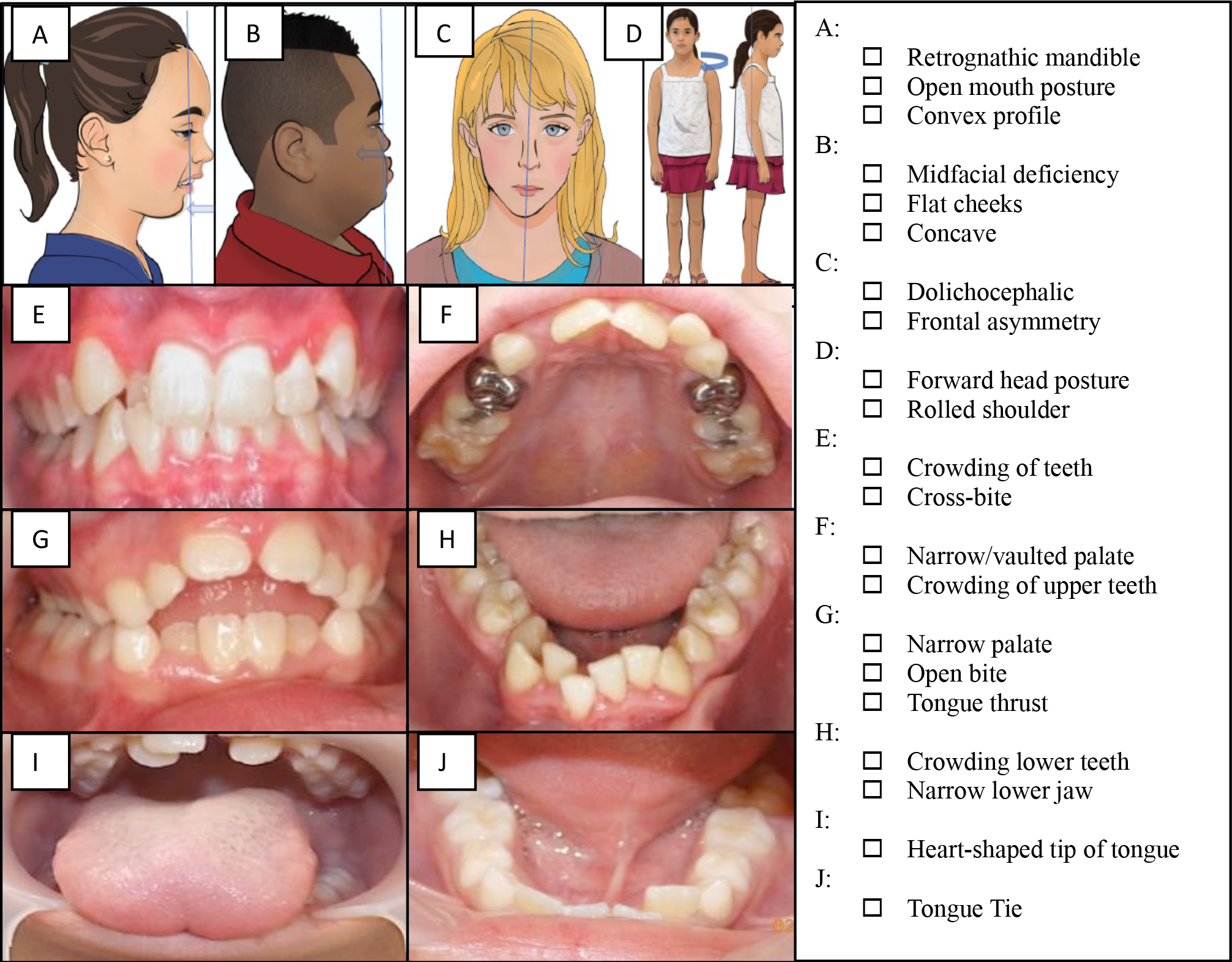Pediatric craniofacial
screening tool for sleep (PCSS). The PCSS includes 21 unique craniofacial
features associated with an increased risk of obstructed breathing in children
and includes mandible placement, facial and cranial distortion, posture, palatal
morphology, teeth crowding, tongue position, and frenulum length. The total score
is the arithmetic sum of craniofacial features.