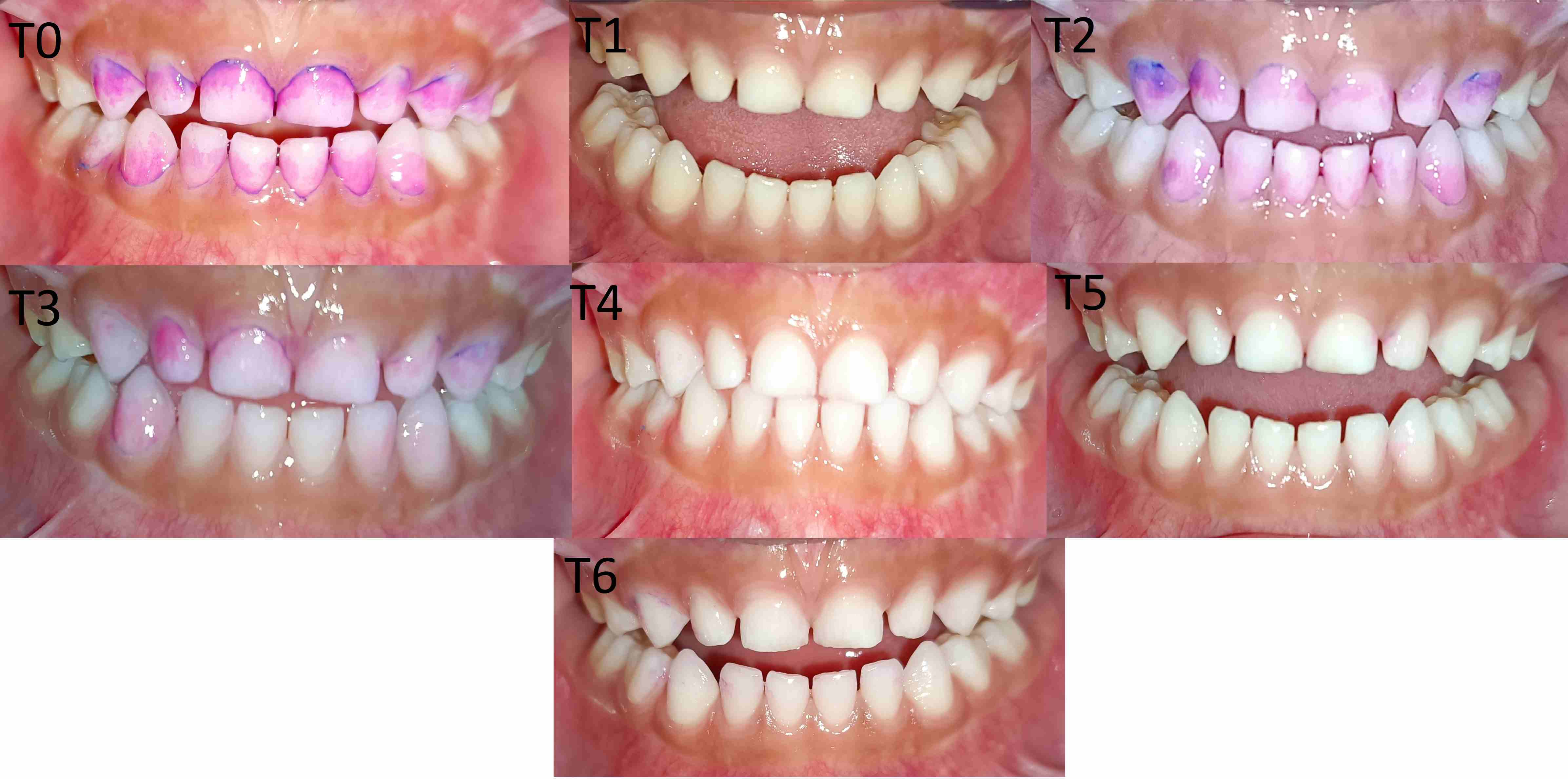 Assessment of plaque accumulation at different time points in
group 1. T0: Before brushing in the group 1; T1: Immediately after brushing using
a traditional toothbrush; T2: 7 days after brushing using a traditional
toothbrush; T3: 21 days after brushing using a traditional toothbrush; T4:
Immediately after brushing using a U-shaped toothbrush; T5: 7 days after brushing
using a U-shaped toothbrush; and T6: 21 days after brushing using a U-shaped
toothbrush.