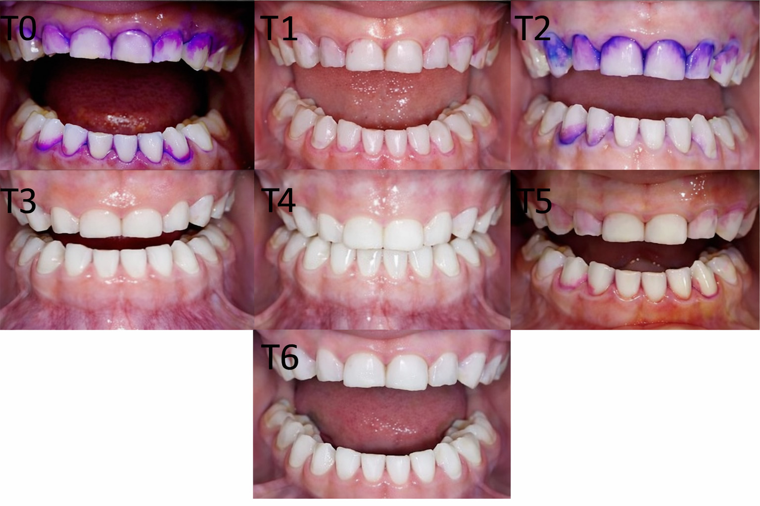 Assessment of plaque accumulation at different time points in
group 2. T0: Before brushing in the group 2; T1: Immediately after brushing using
a U-shaped toothbrush; T2: 7 days after brushing using a U-shaped toothbrush; T3:
21 days after brushing using a U-shaped toothbrush; T4: Immediately after
brushing using a traditional toothbrush; T5: 7 days after brushing using a
traditional toothbrush; and T6: 21 days after brushing using a traditional
toothbrush.