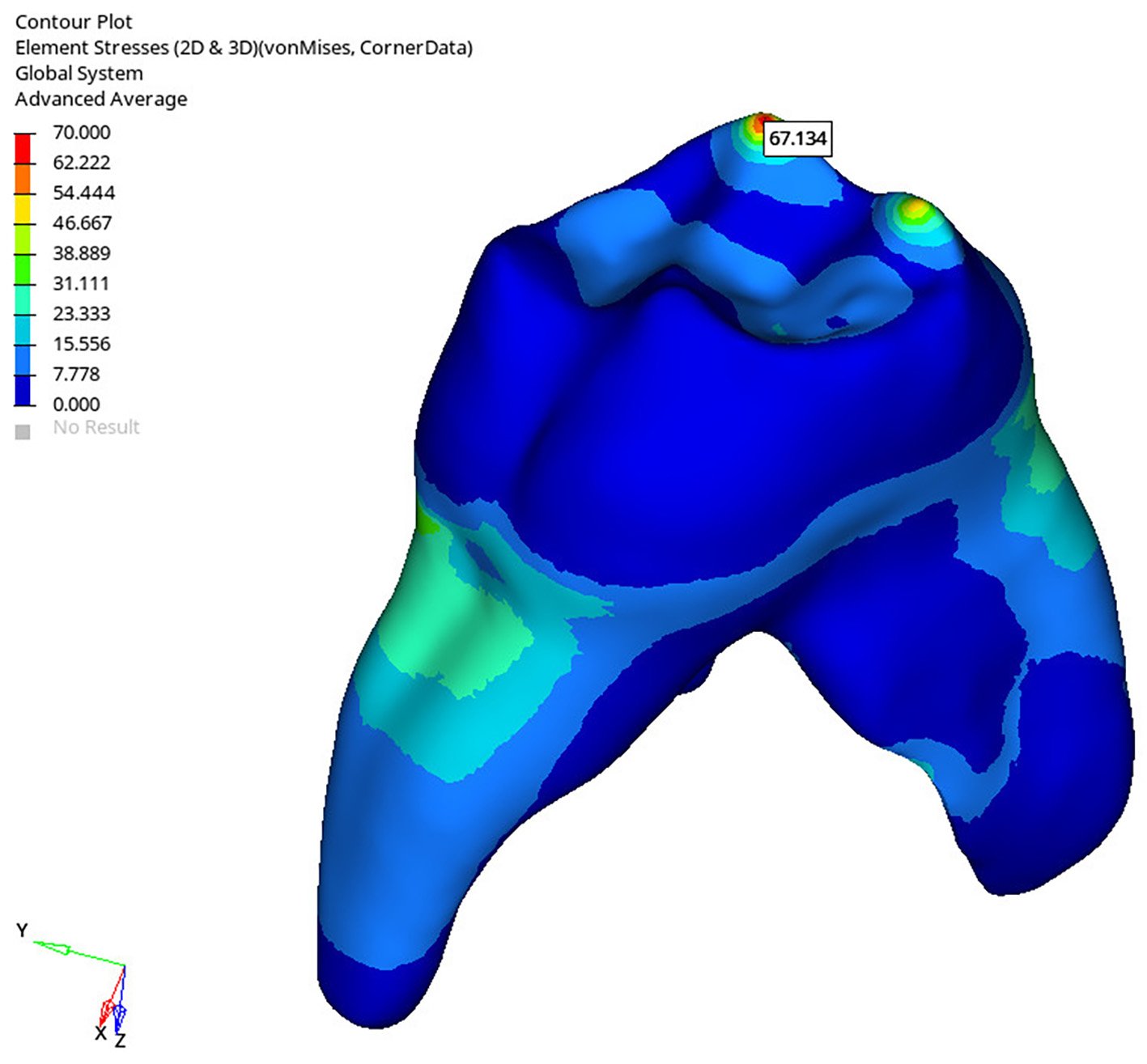 Distribution of stresses occurring in the dentin after applying 
horizontal force at a 90° angle to the long axis of the tooth on a 
healthy tooth model.