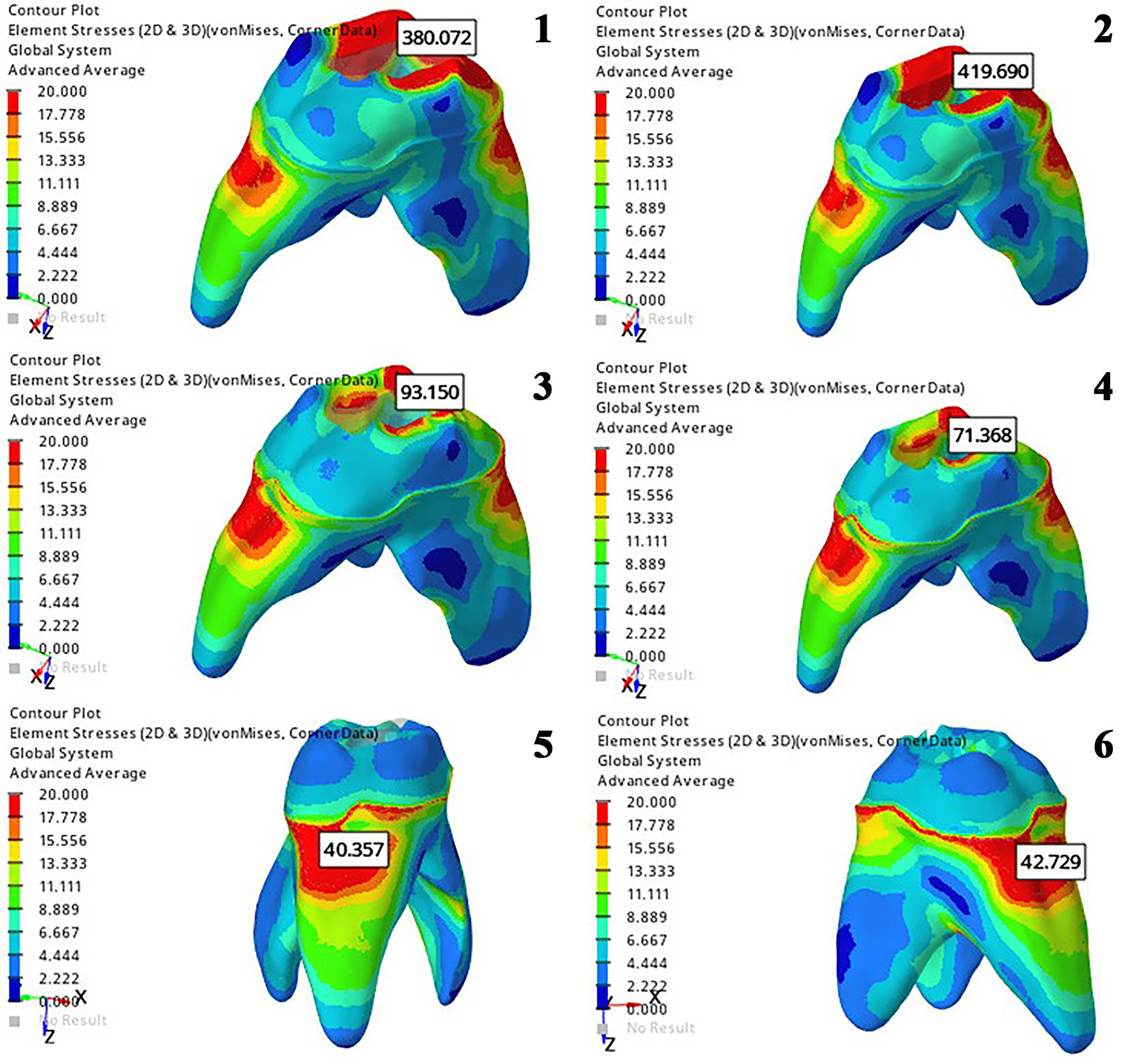 Stress distributions on the dentin tissue after applying a 
horizontal force at a 90° angle to the long axis of the tooth in the 
study models (Models 1,2,3,4,5,6 from left to right, respectively).
