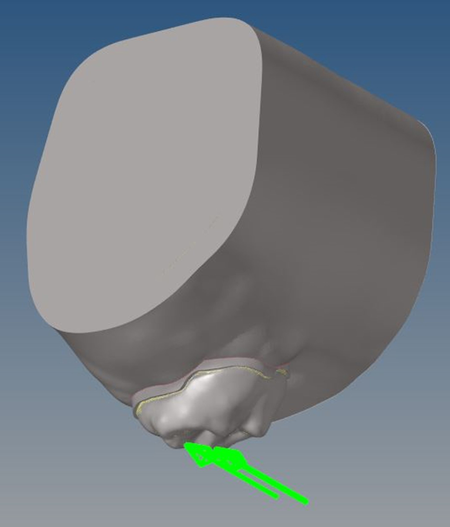 Location and direction of force application. Application of a 
total oblique force of 245 N at a 45° angle toward the palatal slope of 
the buccal cusp.