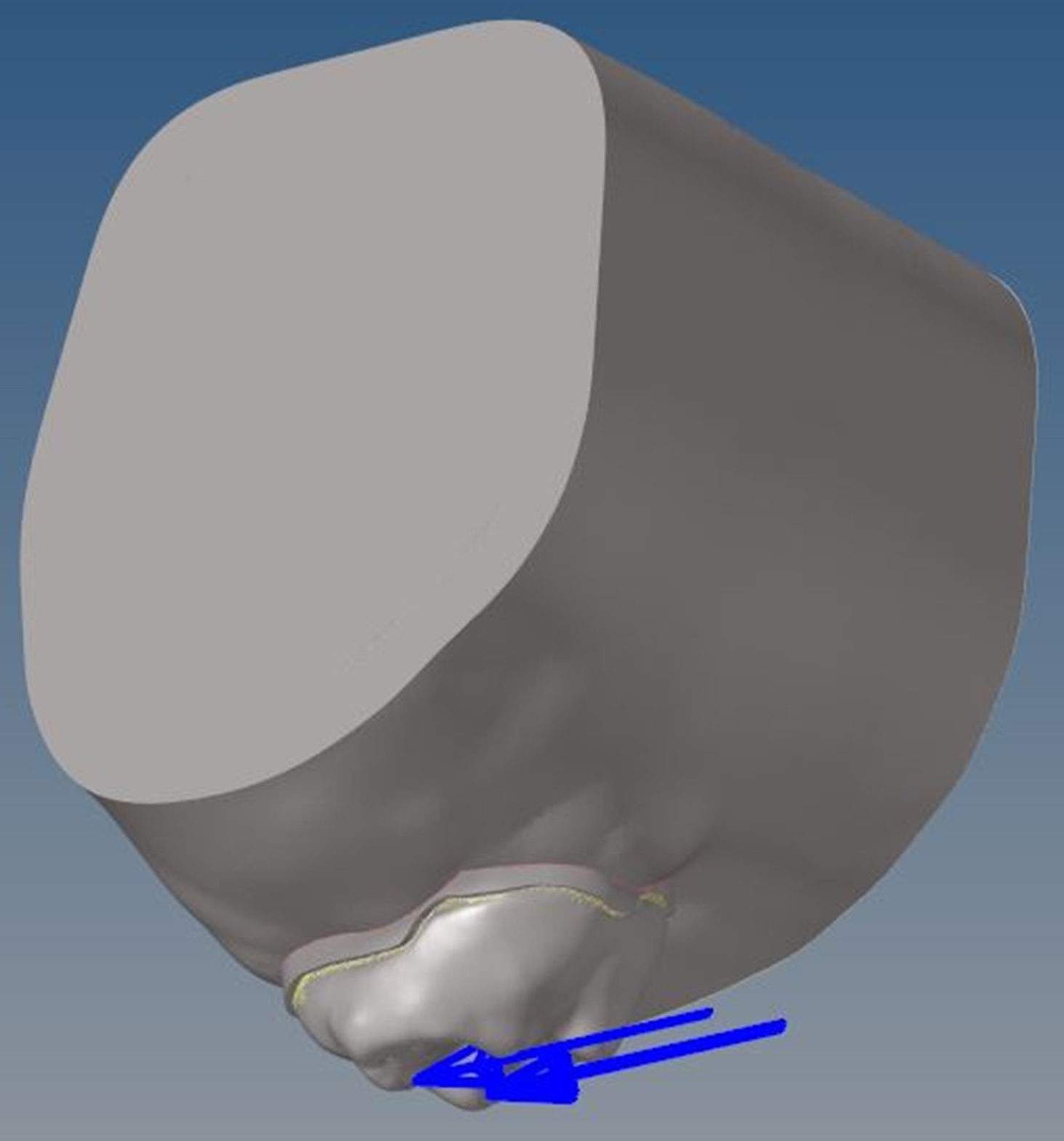 Location and direction of force application. Application of a 
total horizontal force of 245 N at a 90° angle toward the palatal slope 
of the buccal cusp.