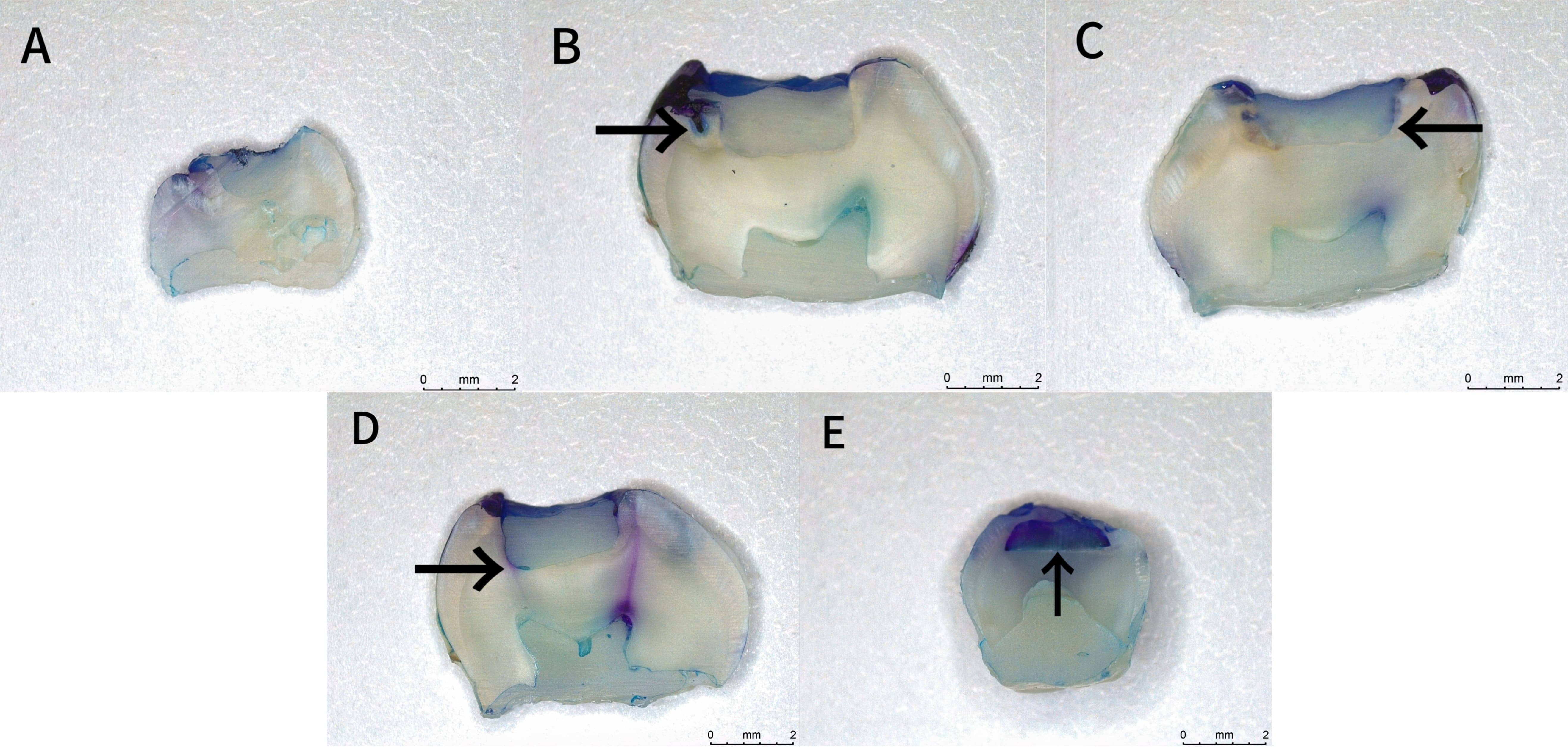 Microleakage grades (body microscope, 5×). (A) Grade 0; 
(B) Grade 1; (C) Grade 2; (D) Grade 3; (E) Grade 4. Black arrows indicate leakage 
depth.