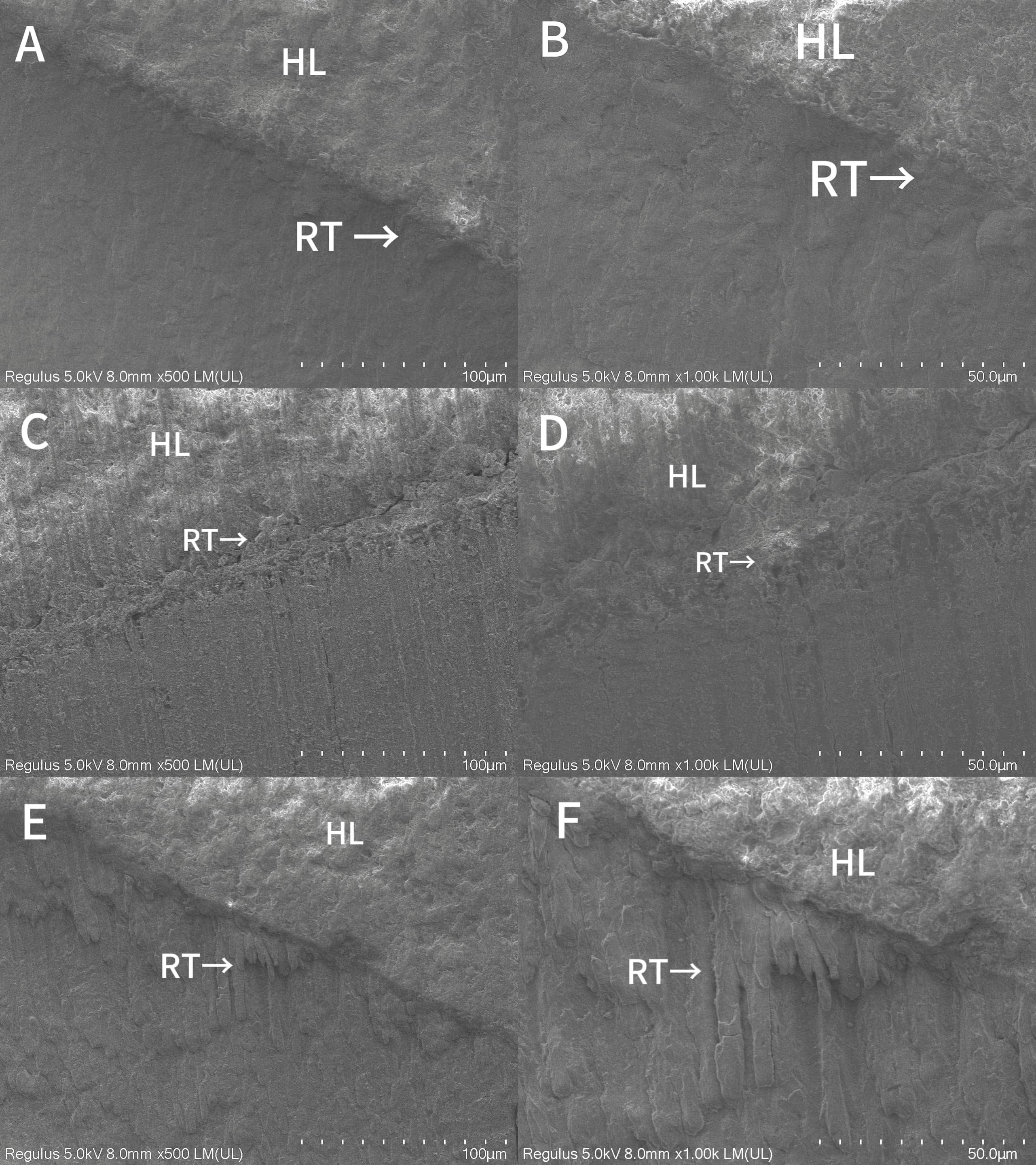 The bonding interface morphology of the immediate groups 
pretreated with various solutions under SEM. (A) Distilled water pretreatment 
group (500×); (B) Distilled water pretreatment group (1000×); 
(C) CHX pretreatment group (500×); (D) CHX pretreatment group 
(1000×); (E) TFs pretreatment group (500×); (F) TFs 
pretreatment group (1000×). HL: Hybrid layer; RT: Resin tag.