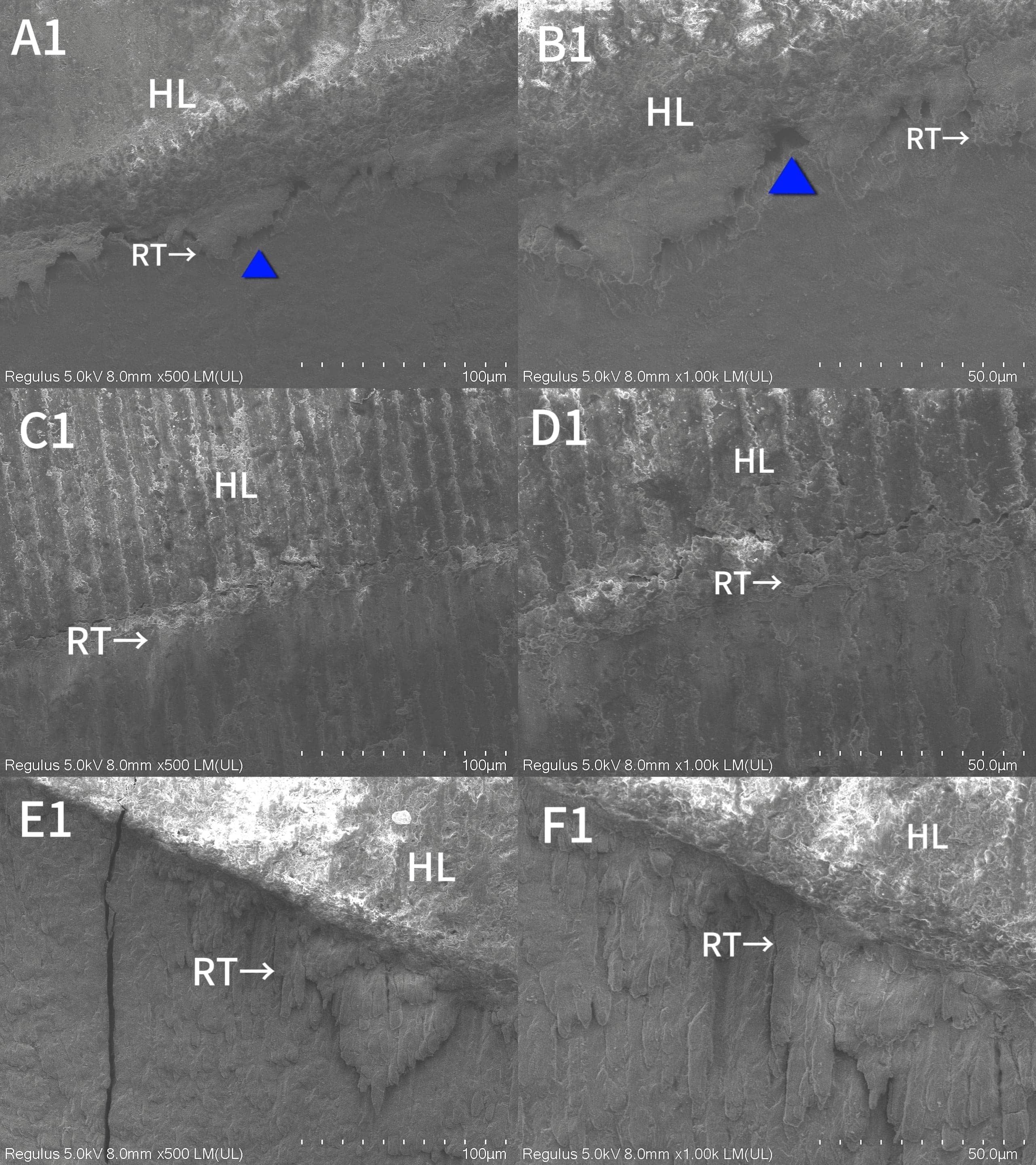 The bonding interface morphology of the aged groups pretreated 
with various solutions under SEM. (A1) Distilled water pretreatment group 
(500×); (B1) Distilled water pretreatment group (1000×); (C1) 
CHX pretreatment group (500×); (D1) CHX pretreatment group 
(1000×); (E1) TFs pretreatment group (500×); (F1) TFs 
pretreatment group (1000×). HL: Hybrid layer; RT: Resin tag. Blue 
triangular icons indicate cracks.