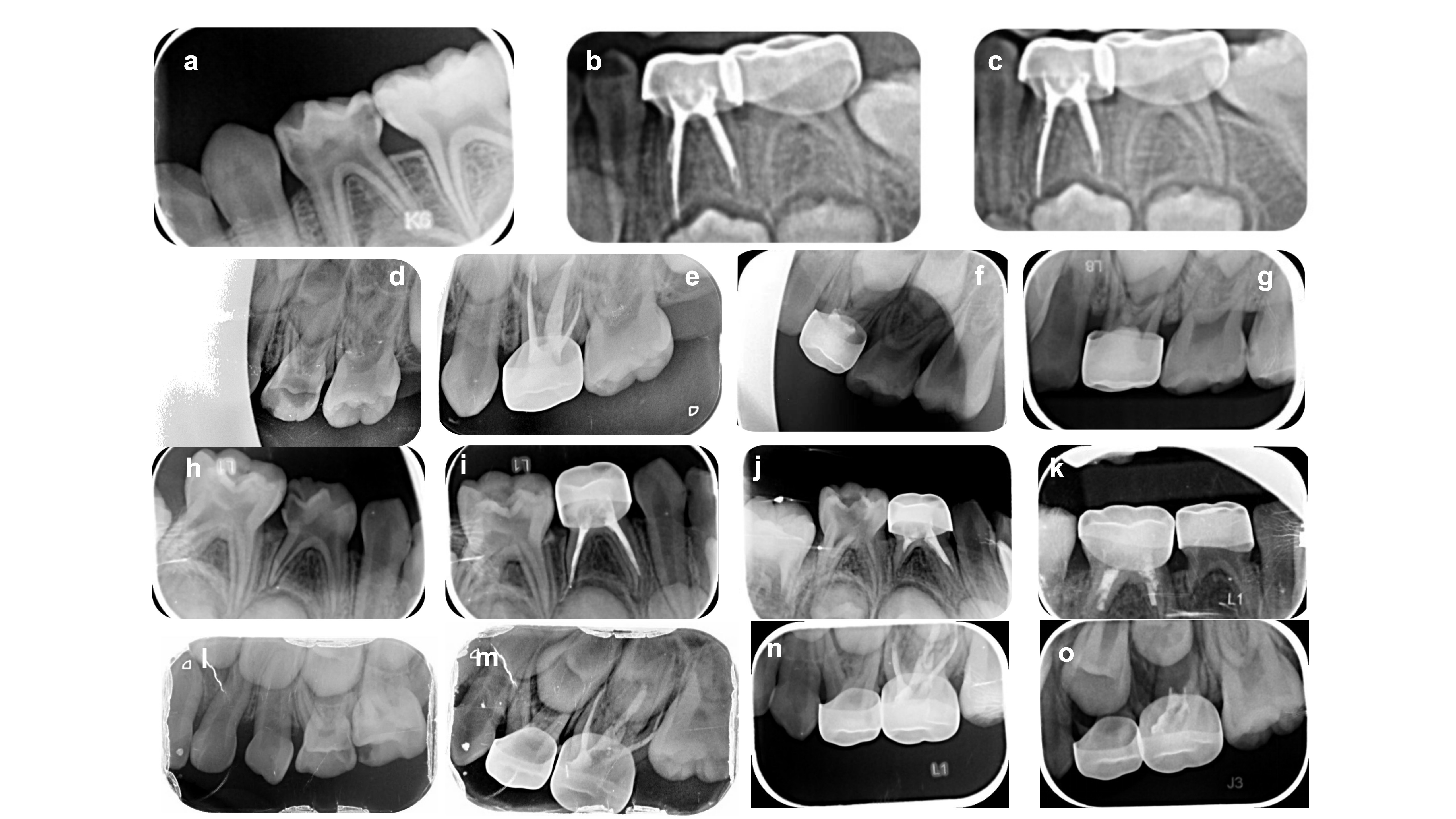 Representative radiographs showing survival and failed cases. 
(a) Pre-treatment radiograph: 5Y3M, F, #74, N. (b) Twelve-month follow-up 
radiograph. (c) Twenty-nine-month follow-up radiograph showing clear periodontium 
and no periapical radiolucency in the periapical region. (d) Pre-treatment 
radiograph: 4Y2M, M, #64, H. (e) Immediate postoperative radiograph. (f) 
Thirty-five-month follow-up radiograph. (g) Fifty-eight-month follow-up 
radiograph showing intracanal filling resorption without periapical lesion. (h) 
Pre-treatment radiograph: 5Y2M, M, #84, P0. (i) Immediate postoperative 
radiograph. (j) Five-month follow-up radiograph. (k) Twenty-month follow-up 
radiograph showing root resorption, but presence of continuous bony white line of 
the permanent tooth. (l) Pre-treatment radiograph: 4Y4M, F, #65, Px. (m) 
Immediate postoperative radiograph. (n) Twelve-month follow-up radiograph. (o) 
Twenty-three-month follow-up radiograph showing periapical low-density 
radiolucency and discontinuous bony white line of the permanent tooth.