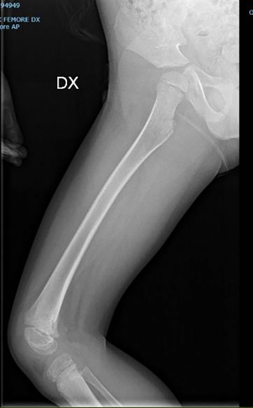 Radiograph of the right femur showing irregularities along the 
lateral contour of the femoral neck and the margin of the distal metaphysis. DX: 
right (right side); AP: anteroposterior (projection).