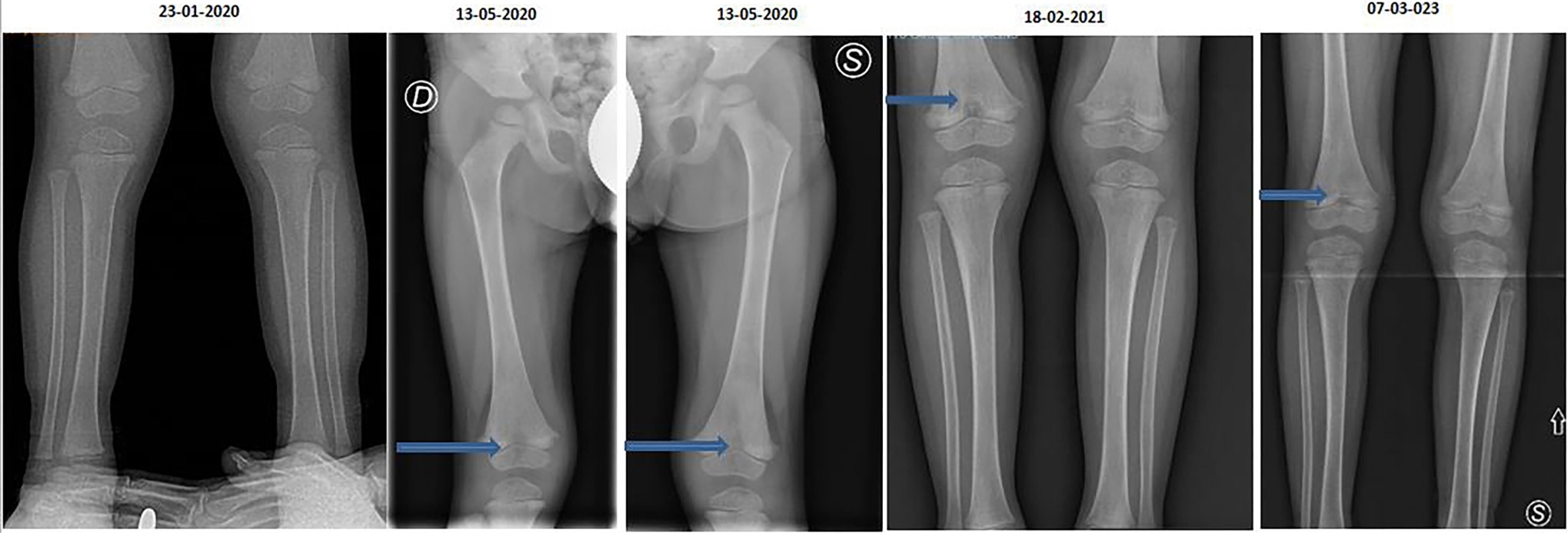 Radiographic follow-up at three years demonstrating stable 
appearance of the distal femoral and proximal tibial metaphysis, with a small 
lingular radiolucency more evident in the distal femur and less 
pronounced in the proximal tibia. The blue arrows indicate areas of 
metaphyseal irregularities and growth plate changes, consistent with mild 
hypophosphatasia manifestations. Ⓓ: right side; Ⓢ: left side; ⇧: cranial.