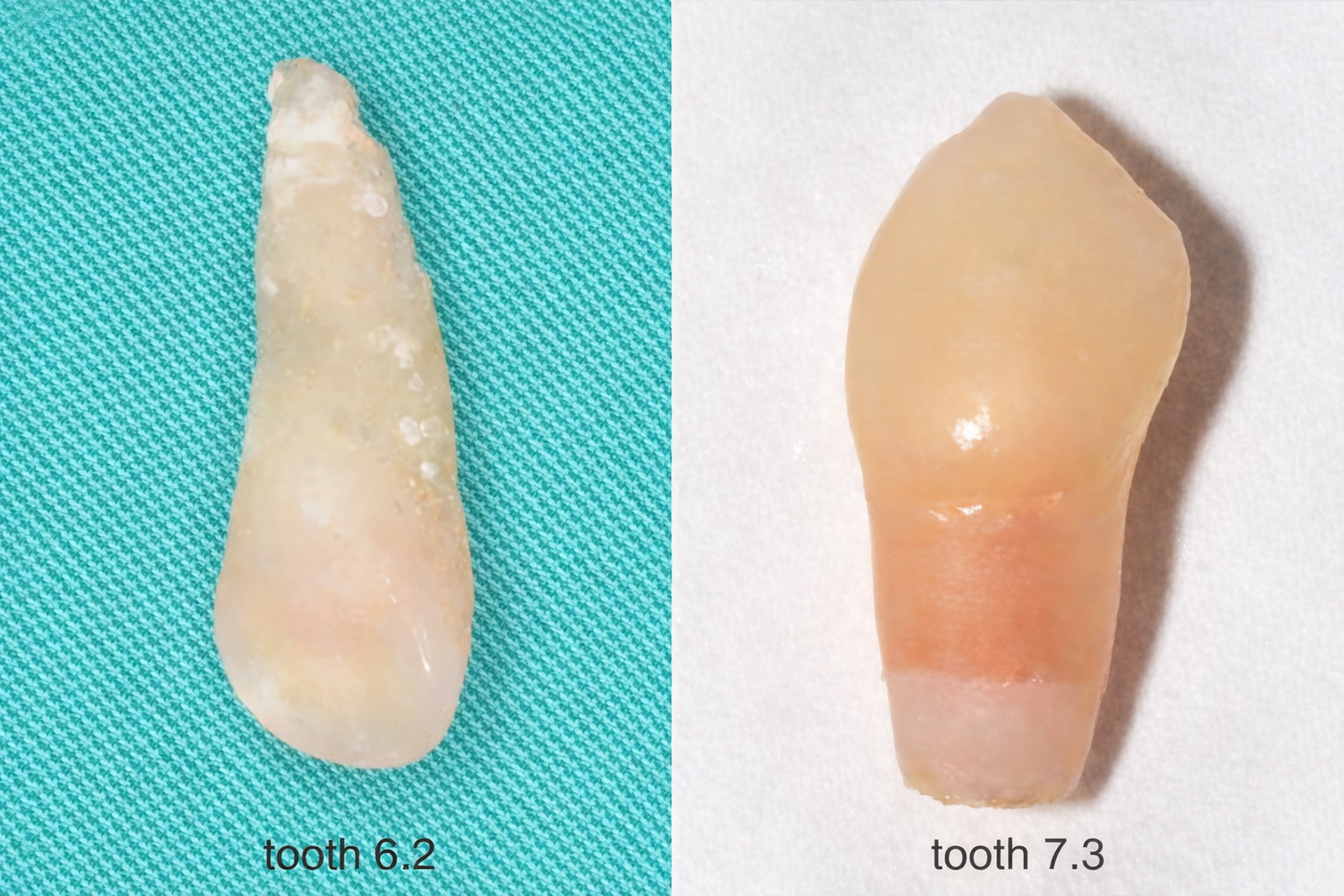 Exfoliated teeth (6.2, 7.3) showing unresorbed 
roots exceeding two-thirds of the total root length, with no evidence of carious 
lesions.