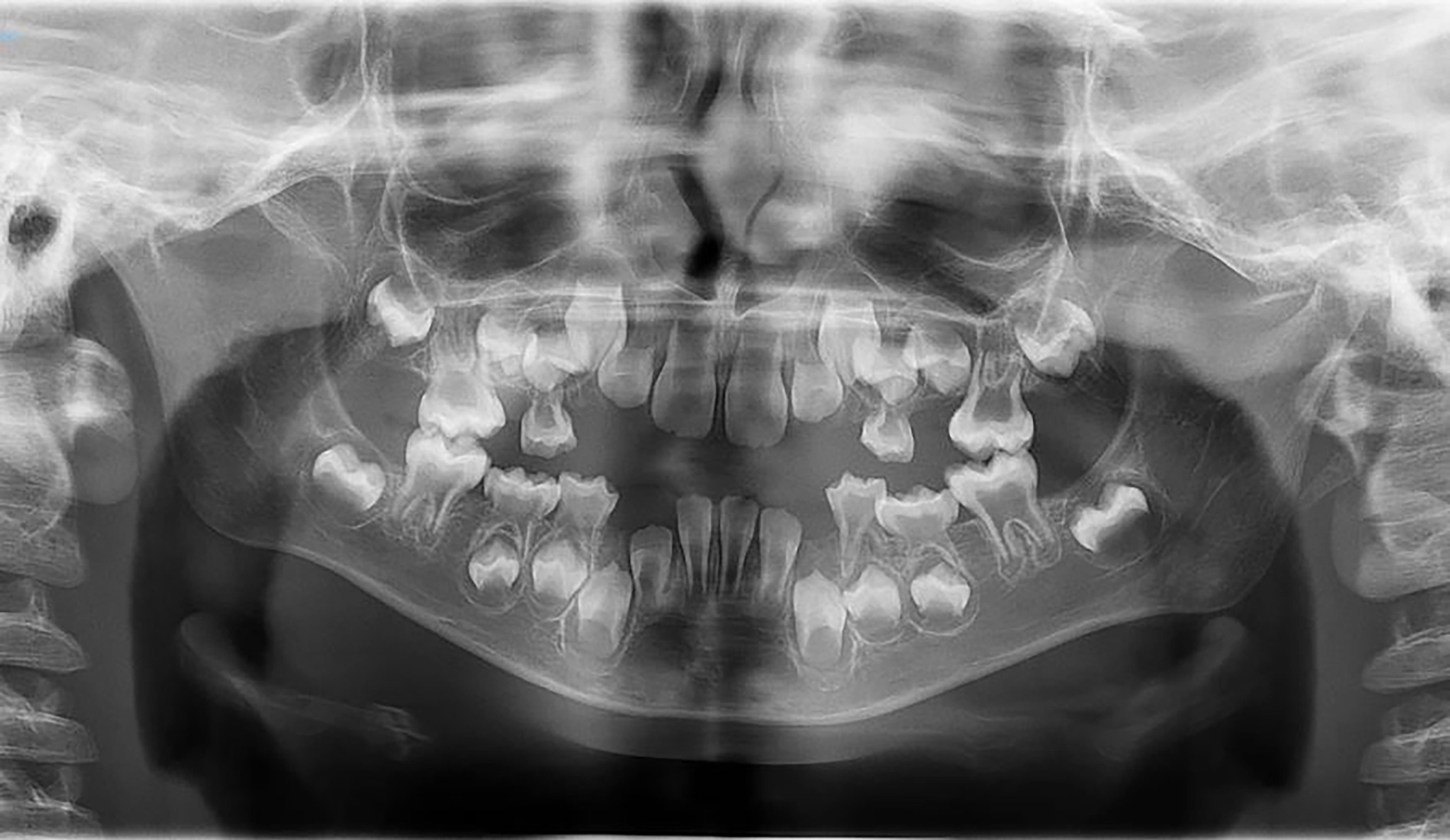 Orthopantomography showing reduced alveolar bone height, short 
and tapered roots, enlarged pulp chambers, and root canals.