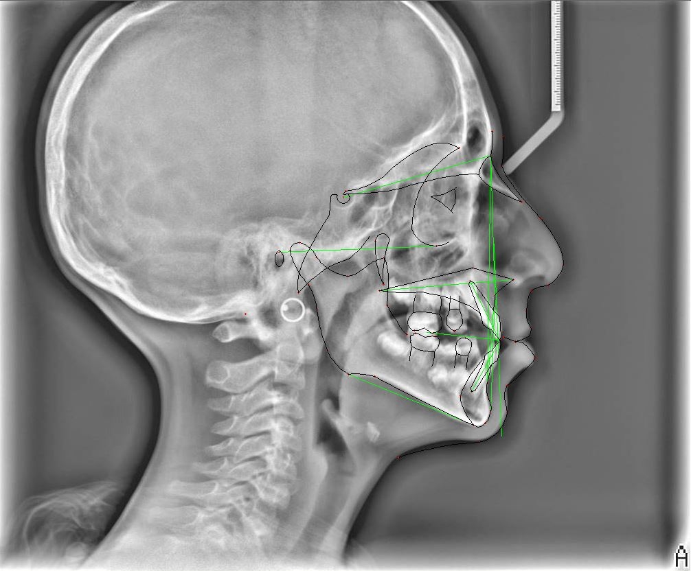 Lateral cephalometric radiograph with cephalometric analysis of 
the patient at 6 years of age used for skeletal and dental evaluation. The black lines represent the traced anatomical contours used as structural references in the analysis, whereas the green lines indicate the cephalometric planes that were measured for the angular and linear assessments.