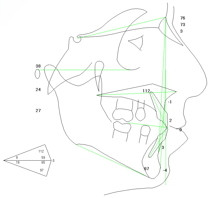 Cephalometric analysis according to the Bennet–McLaughlin 
method, showing a skeletal Class I relationship with a retrognathic maxilla and 
mandible, normo-bite vertical pattern, and mild proclination of the lower 
incisors. The black lines represent the traced anatomical contours used as structural references in the analysis, whereas the green lines indicate the cephalometric planes that were measured for the angular and linear assessments.