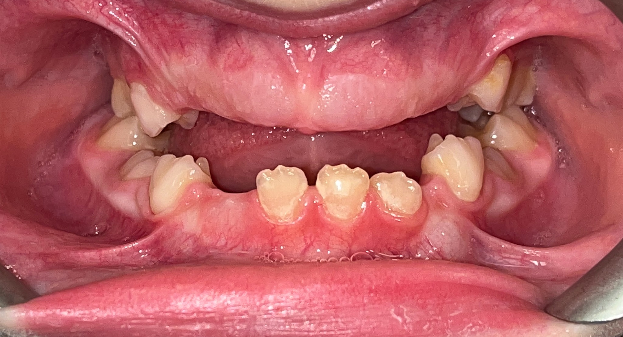 Intraoral photograph after 5 years of follow-up showing the 
initial mixed dentition, well-formed arches, and good alignment of the first 
permanent molars.