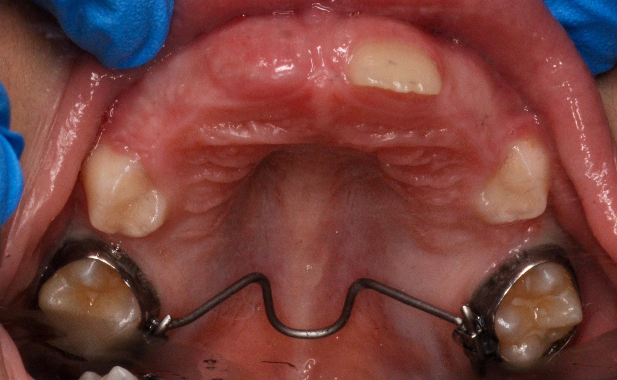 Intraoral photograph in the maxillary occlusal view showing the 
placement of a Transpalatal arch (TPA) in Titanium Molybdenum Alloy (TMA) on the 
permanent first molars.