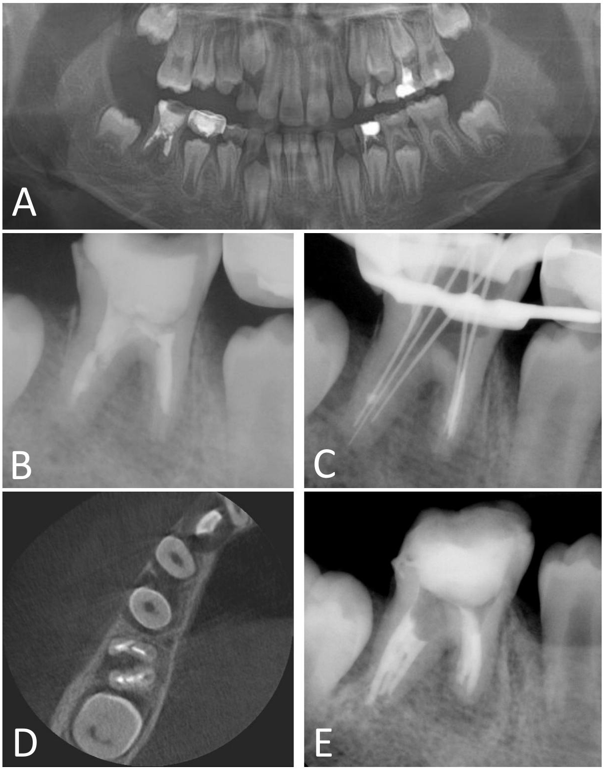 Preoperative radiographs and treatment procedures. (A)
Preoperative panoramic radiograph. (B) Preoperative periapical radiograph. (C)
Initial apical files placed in all canals, with the middle canal measured at a
working length of 17 mm. (D) Cone-beam computed tomography image showing partial
communication between the distal canals through a middle canal. (E)
Post-obturation periapical radiograph.