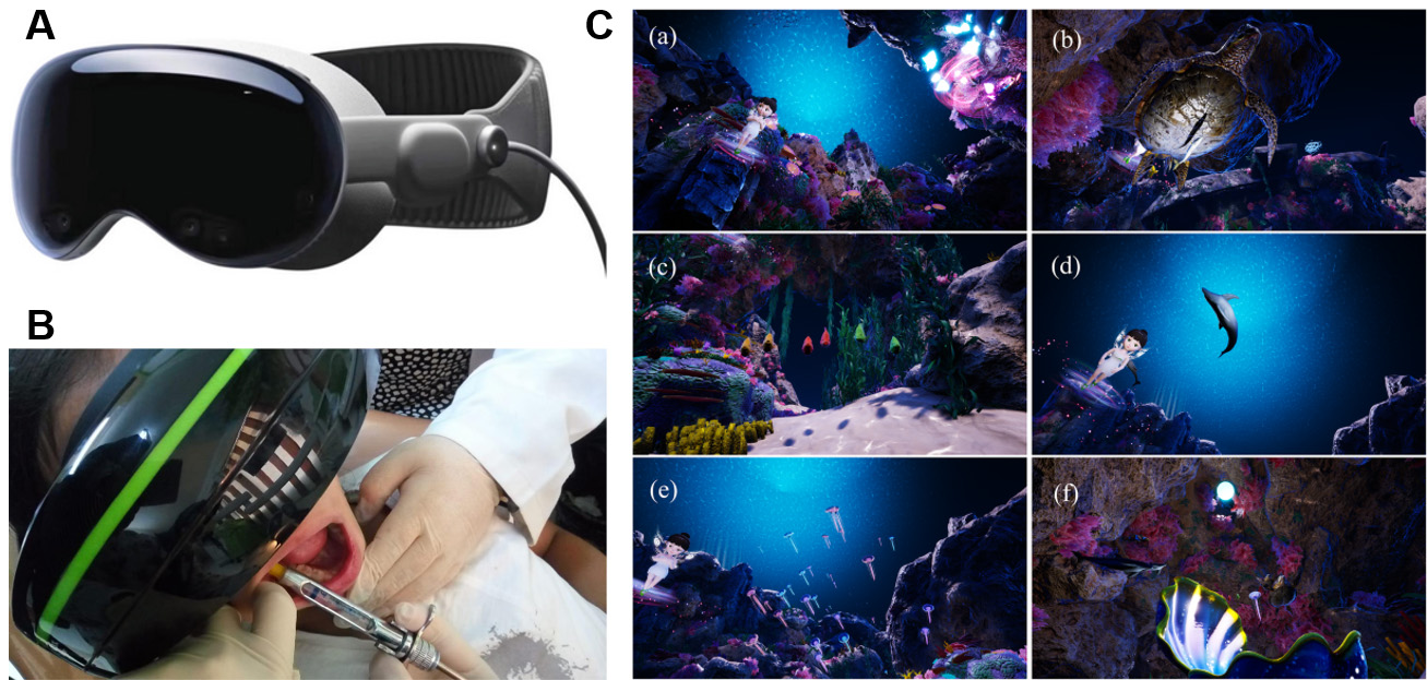 The application of VR to alleviate dental anxiety of children. 
(A) The Apple Vision Pro headset (From Waisberg et al. [23], 2024, 
licensed under CC BY 4.0.). (B) Local anesthesia administration with immersive 
virtual reality (Reproduced from Alshatrat et al. [22], 2022, with 
permission from the John Wiley &amp; Sons, Inc.). (C) Screenshot of custom scenario. 
(a–f) show the storyline of a virtual story scenario. (From Ran et al. 
[24], 2021, licensed under CC BY 4.0.).